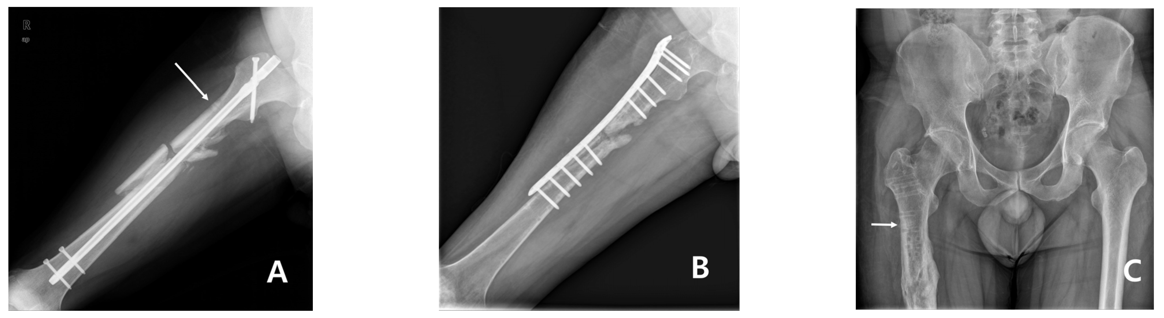 Medicina Free FullText Subtrochanteric Insufficiency Fracture