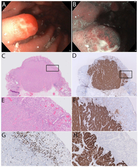 Frontiers | Case Report: Systemic treatment for breast and vulvar  metastases from resected rectal signet ring cell carcinoma