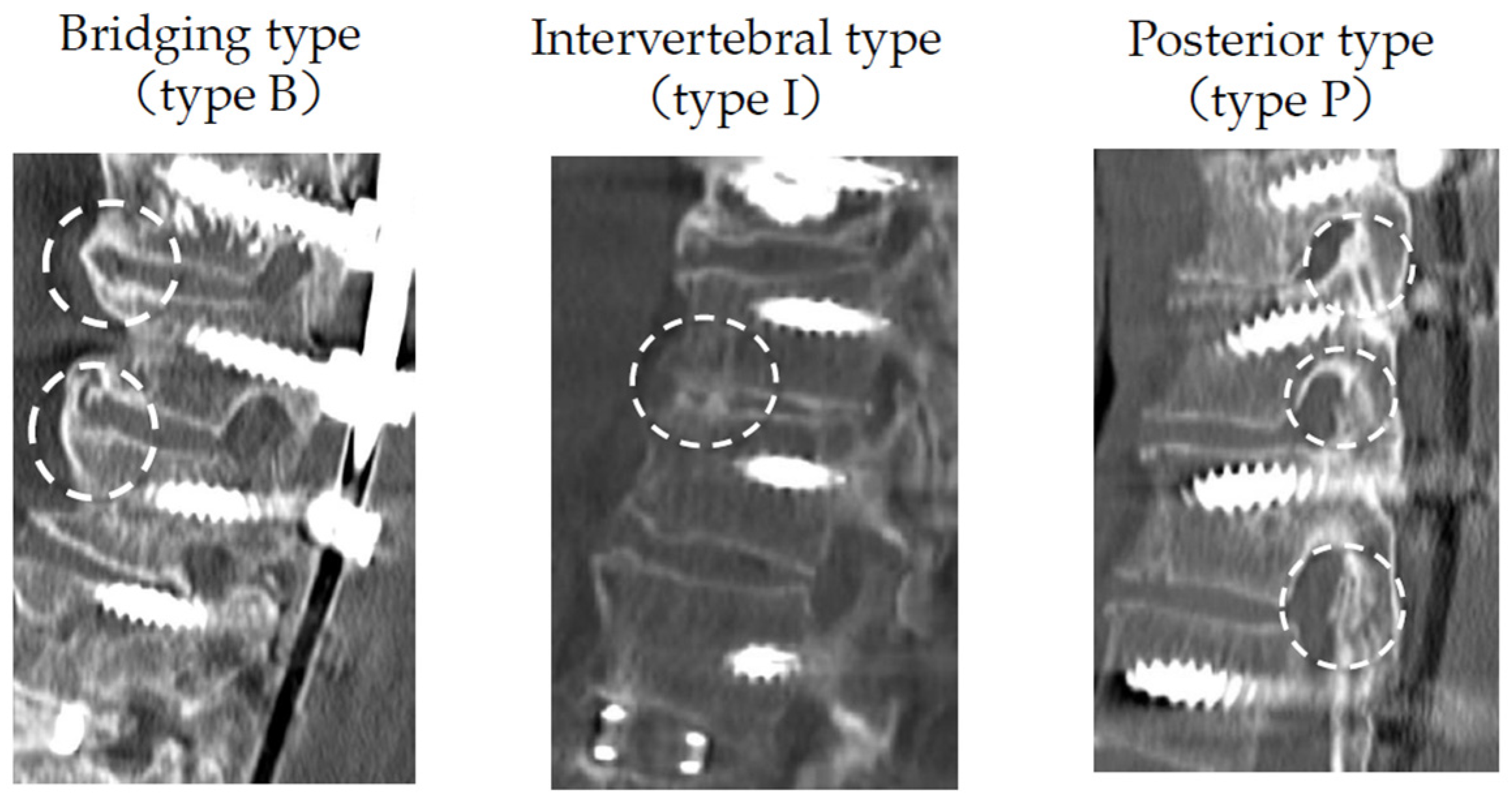 Medicina Free FullText Bone Fusion Morphology after