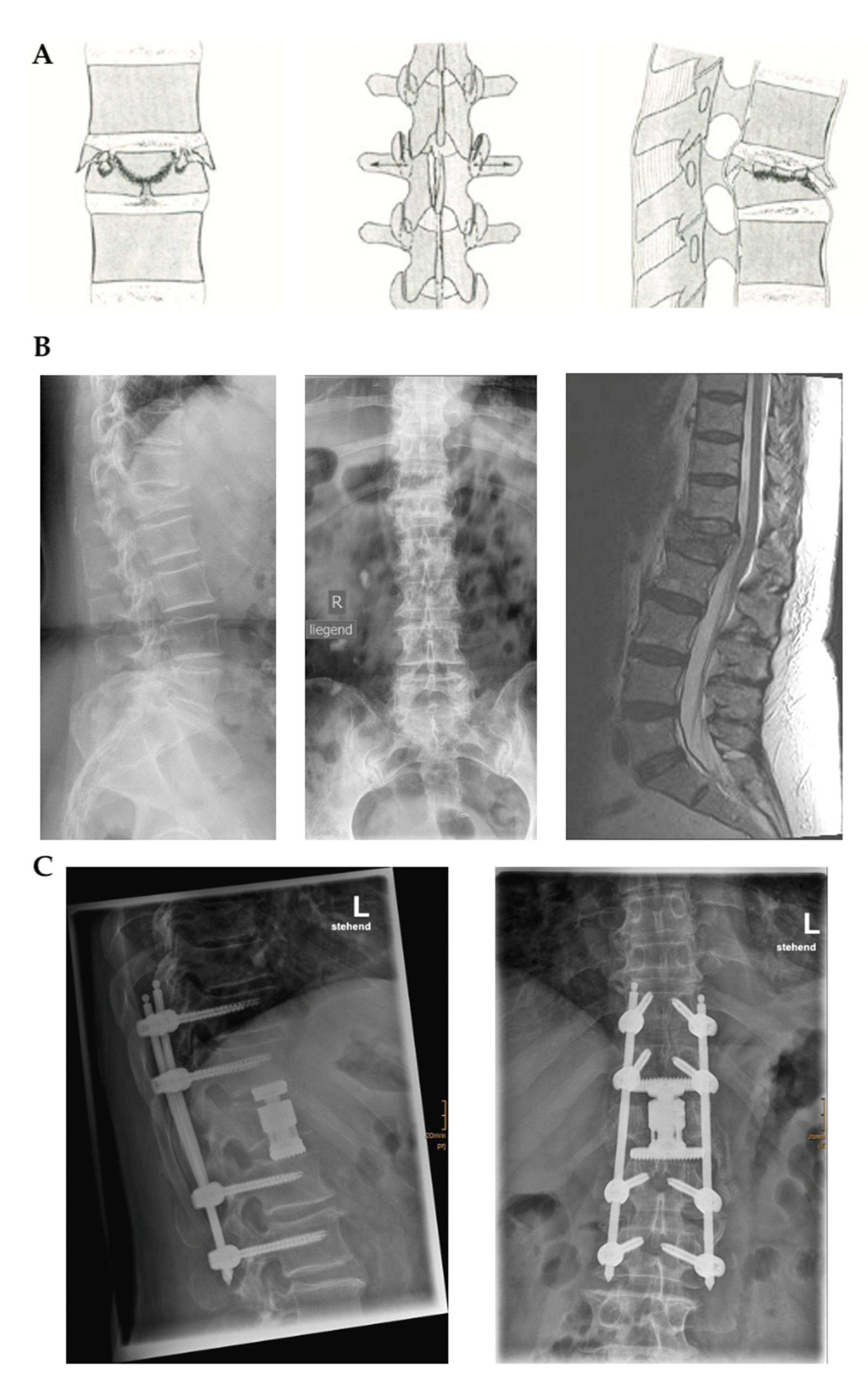 A drawing of a lateral spinal radiograph describing the rib-index