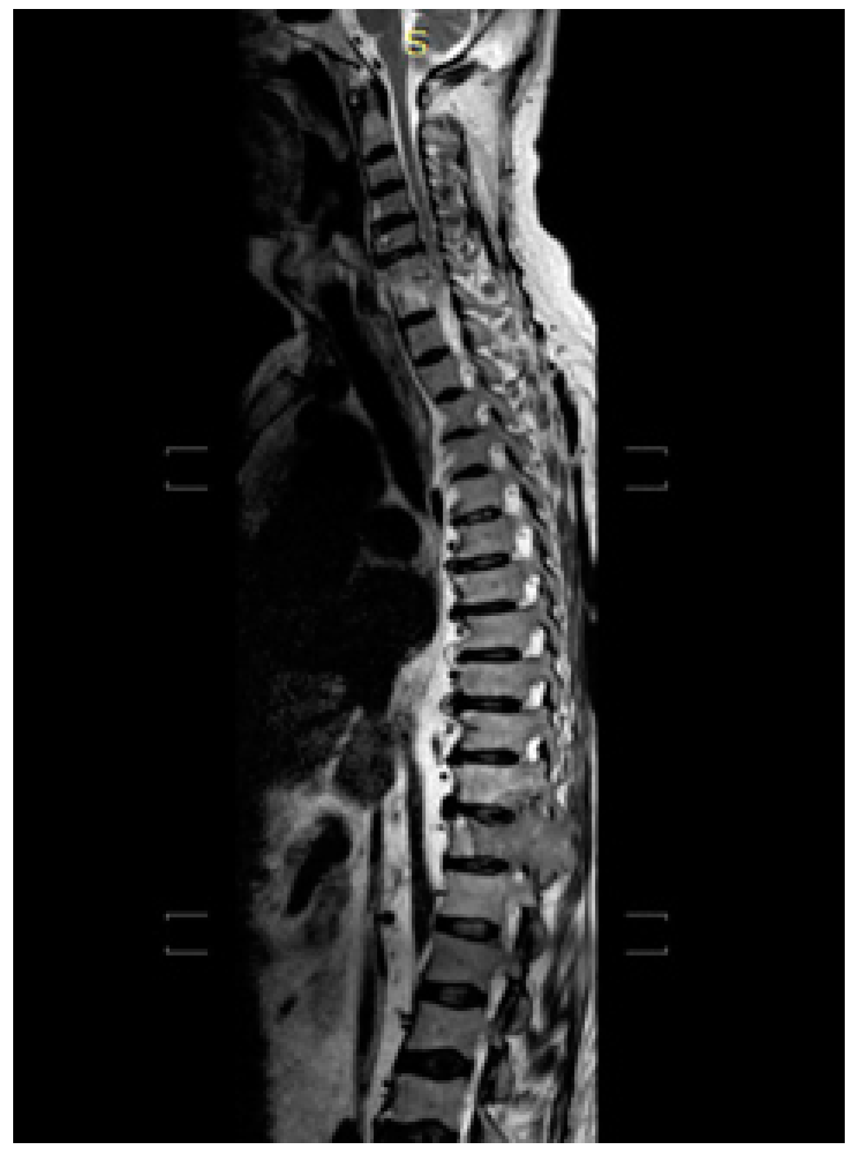 Medicina Free FullText Sorafenib in Metastatic Papillary Thyroid