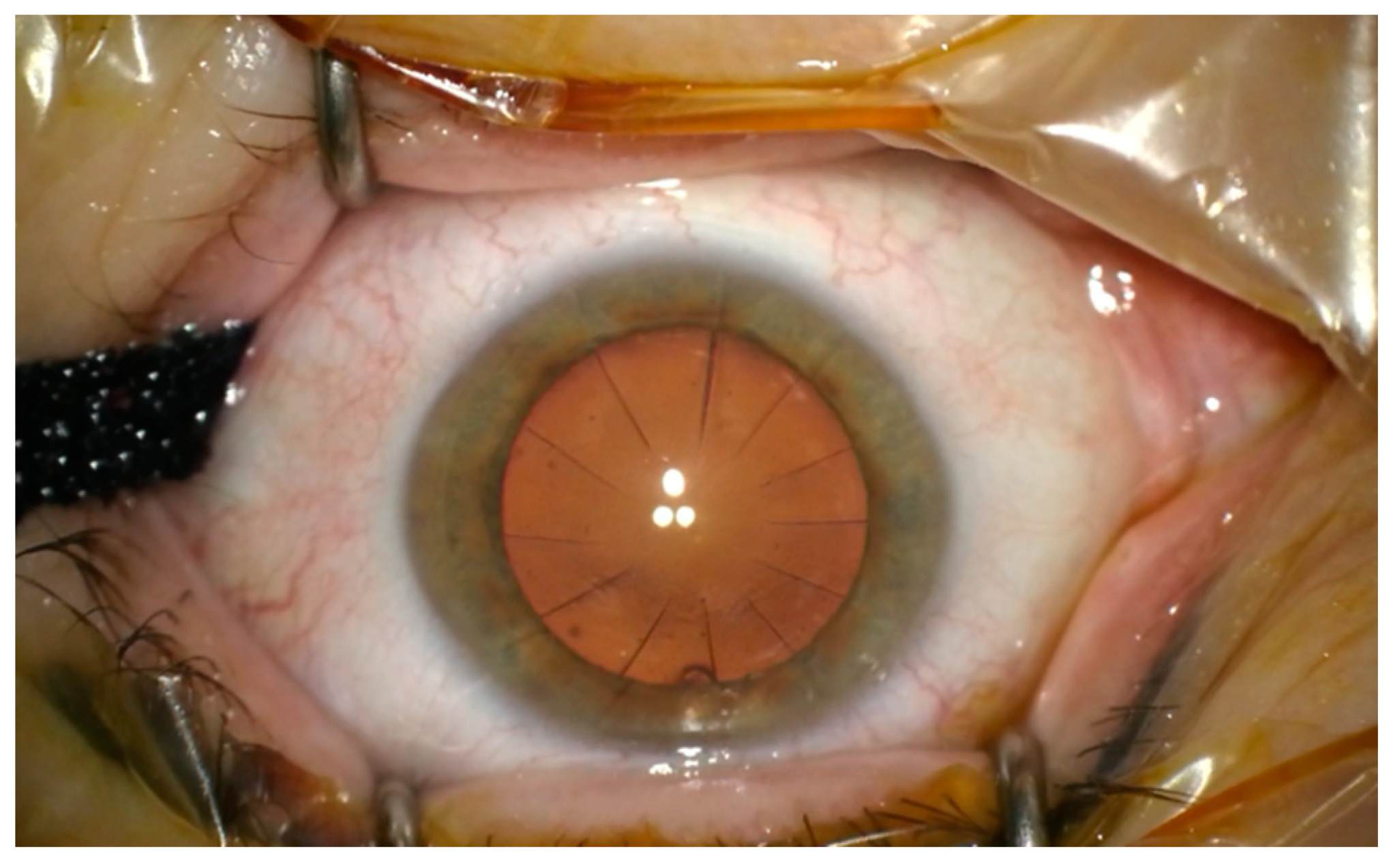 Medicina Free FullText Cataract Surgery after Radial Keratotomy