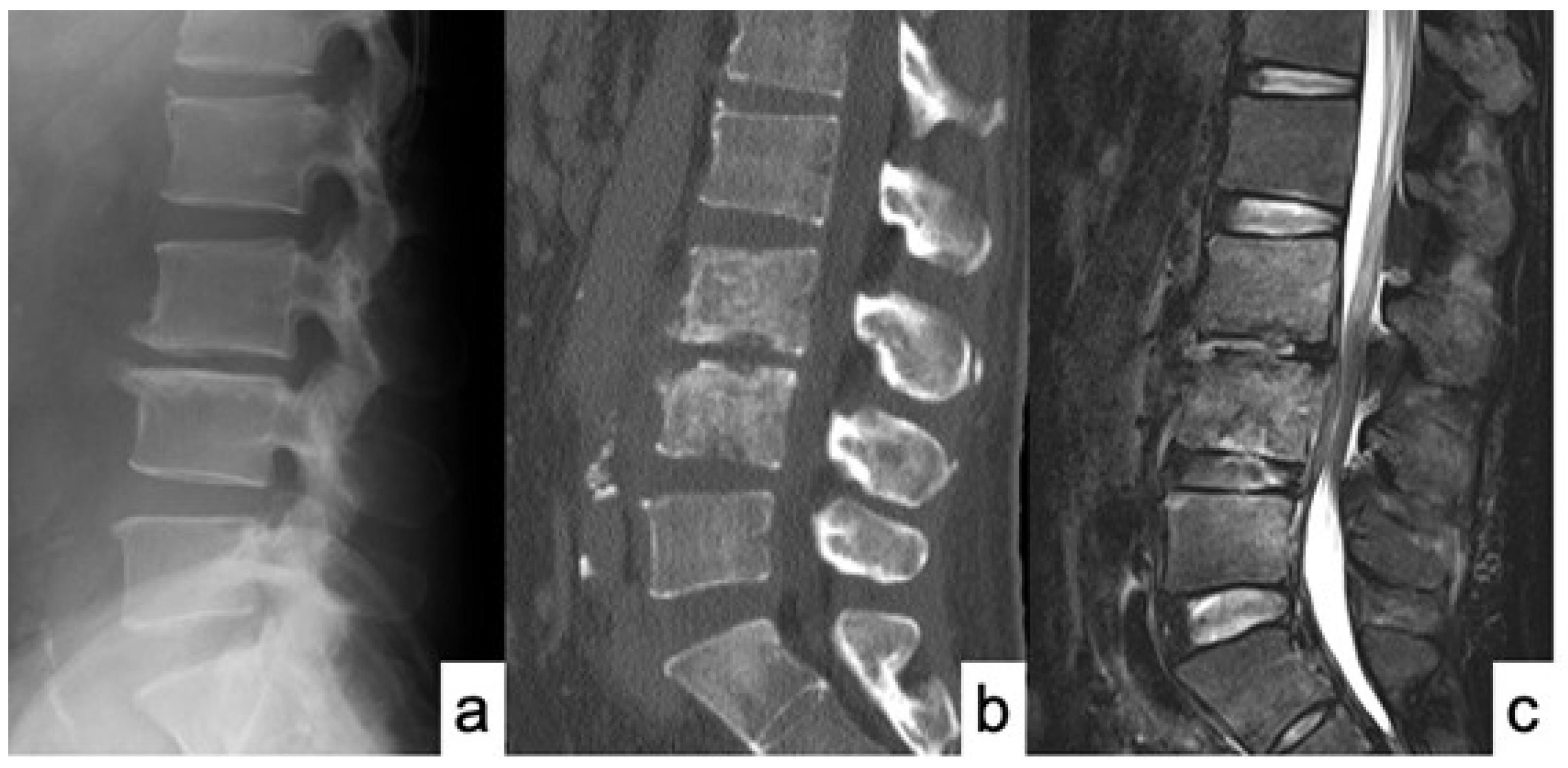 An Evaluation Of The Surgical Outcome Of Idiopathic Lumbar Spondylodiscitis Treated With Posterior Debridement 