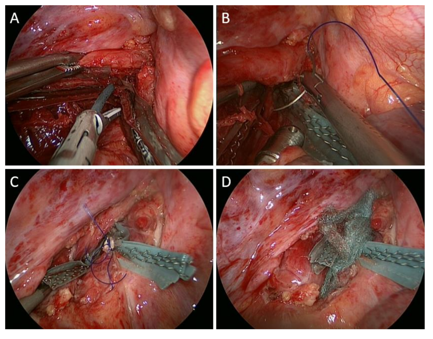 Medicina Free FullText Thoracoscopic Repair of AdultOnset