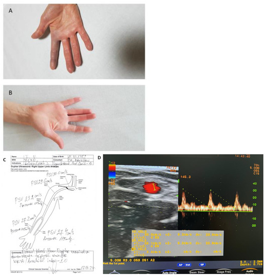 Medicina Free FullText Paroxysmal Finger Hematoma—A Probable