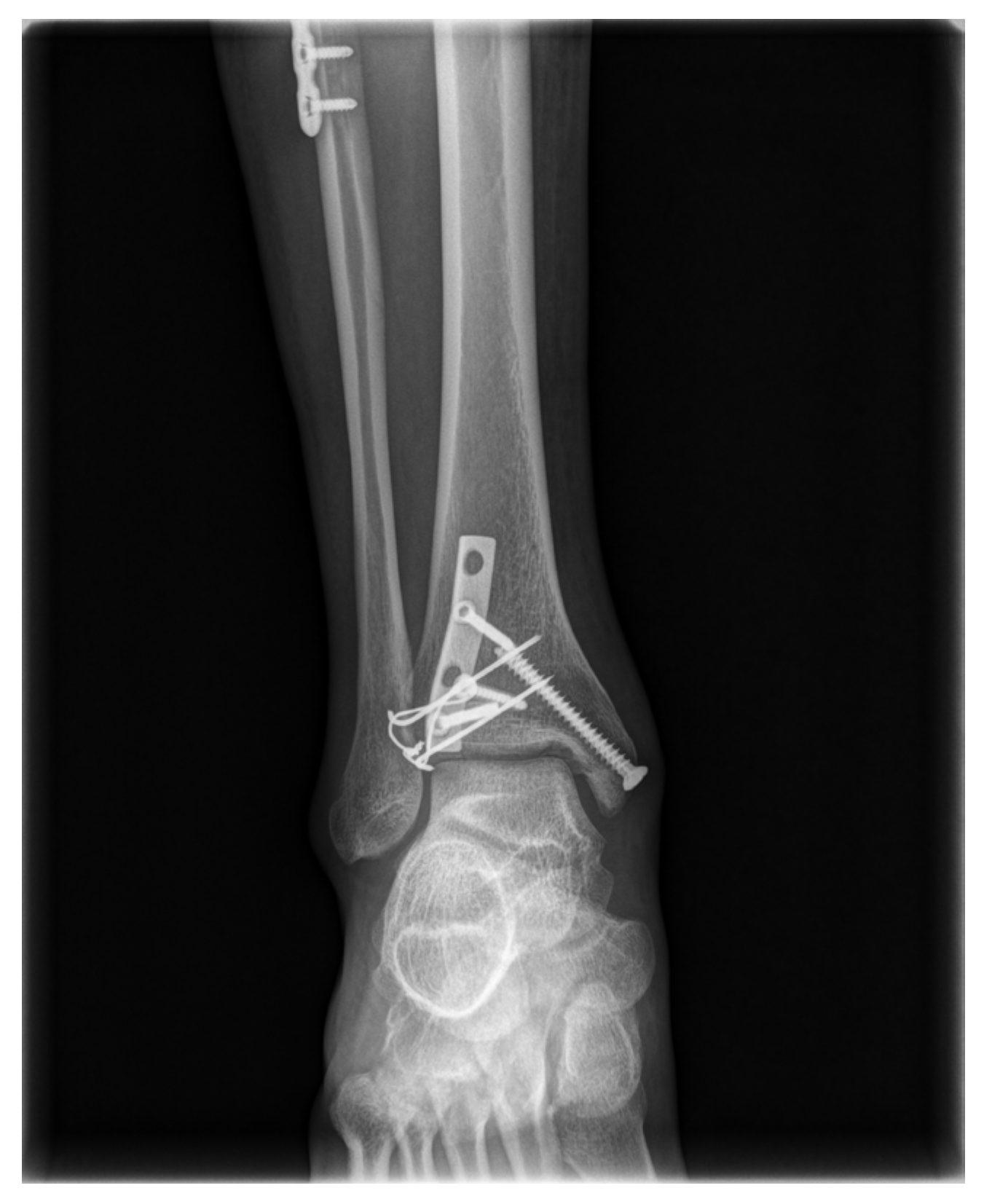 Medicina Free FullText A TensionBand Wiring Technique for Direct