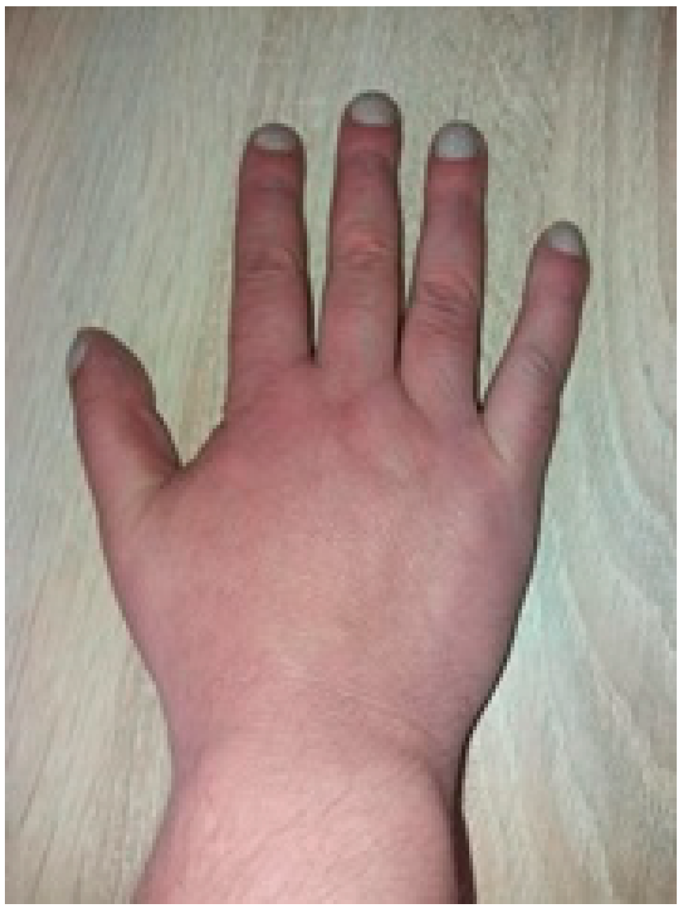 PDF) Pseudoclubbing – a rare manifestation of an uncommon association of  rheumatic diseases