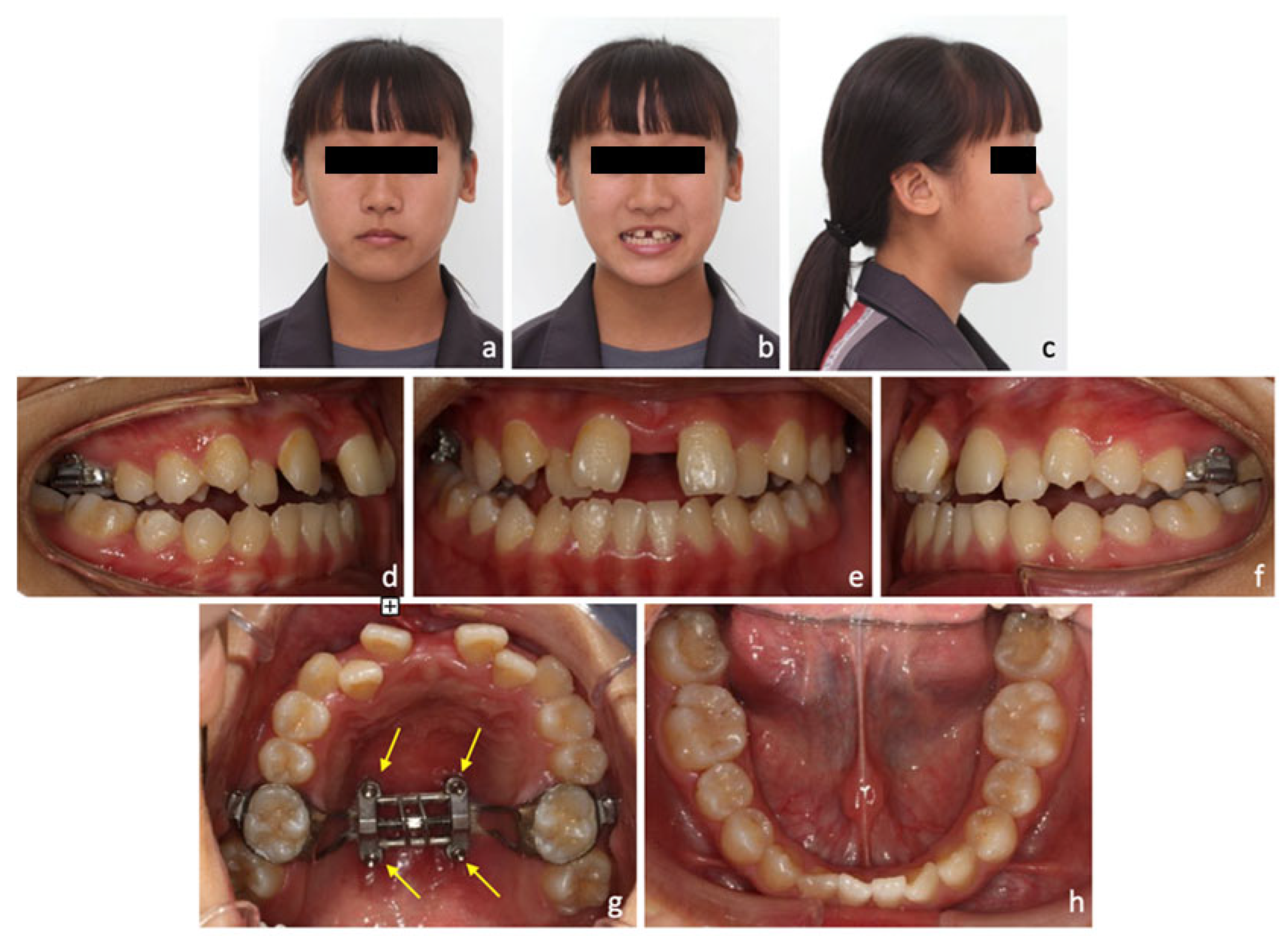 Medicina Free FullText Management of Class III Malocclusion and
