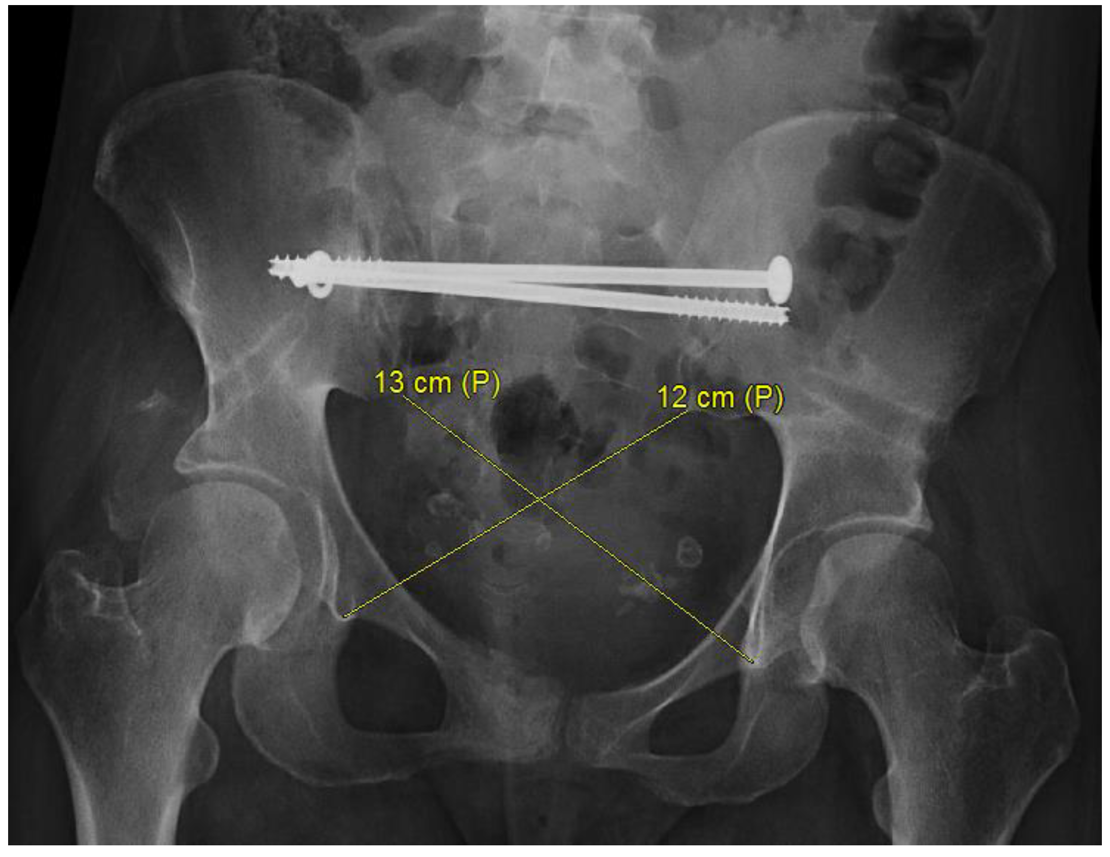Medicina Free Full Text Pelvic Malunion A Systematic Review