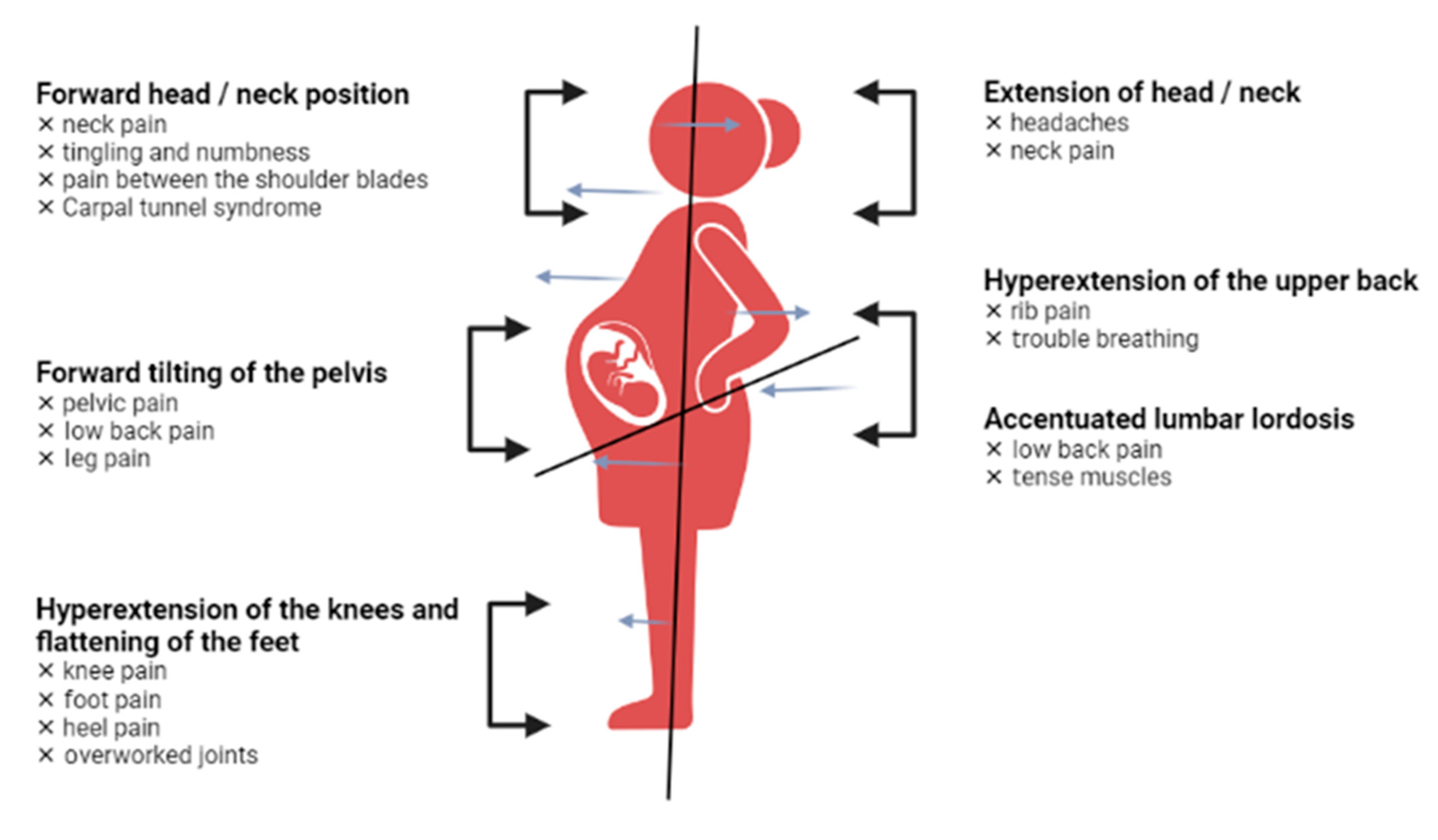 Lordosis Pregnancy lordosis-pregnancy