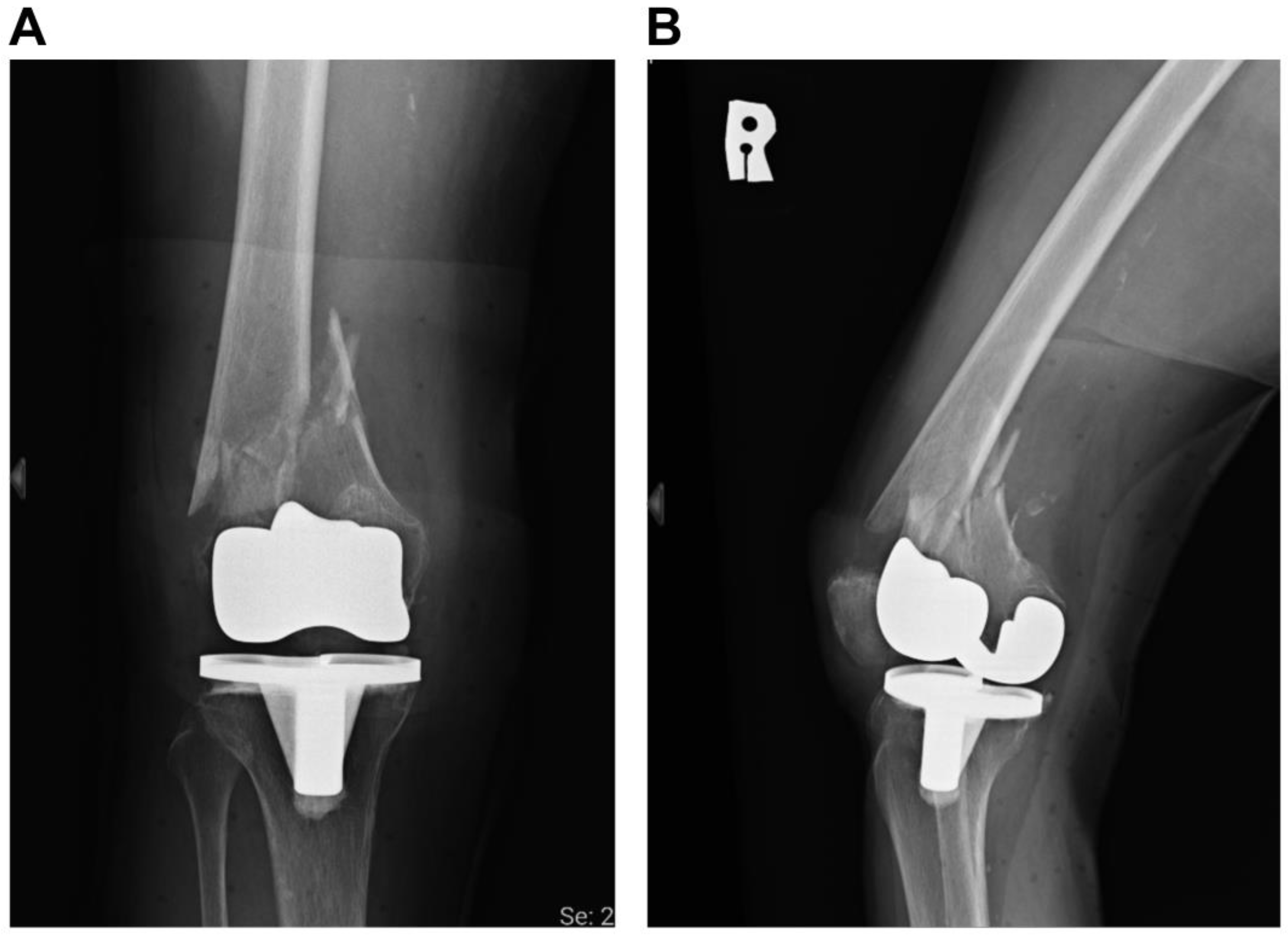 Pubic Rami Fracture Icd 10 - flg85sf