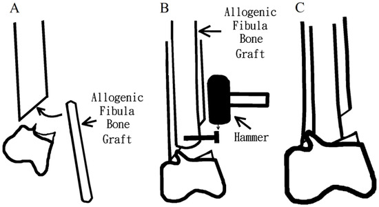 Successful Plate Fixation with Long Intramedullary Fibula Bone Graft ...