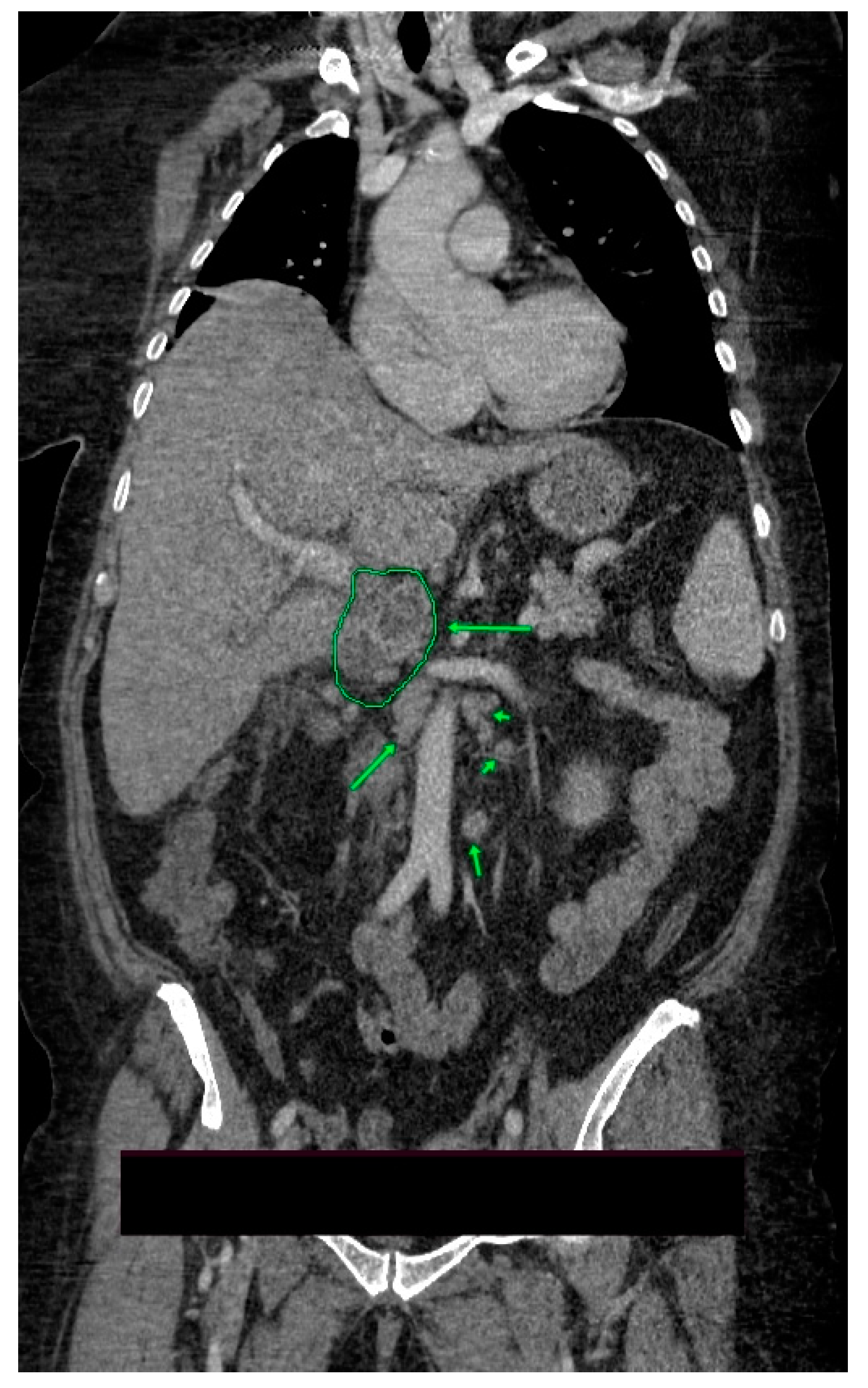 診断病理学：肝胆膵　２版 Hepatobiliary and Pancreas Pancreatic Tuberculosis—A Condition That Mimics Pancreatic