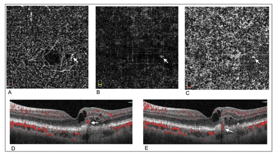 Medicina | Free Full-Text | Early OCTA Changes of Type 3 Macular ...