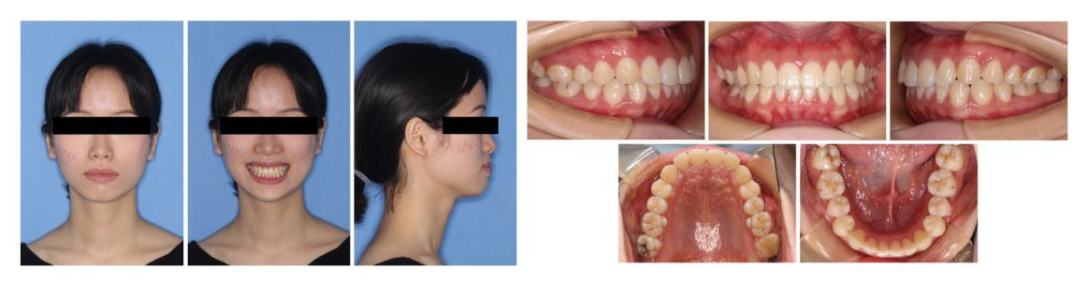 Medicina Free FullText Augmented Corticotomy on the Lingual Side