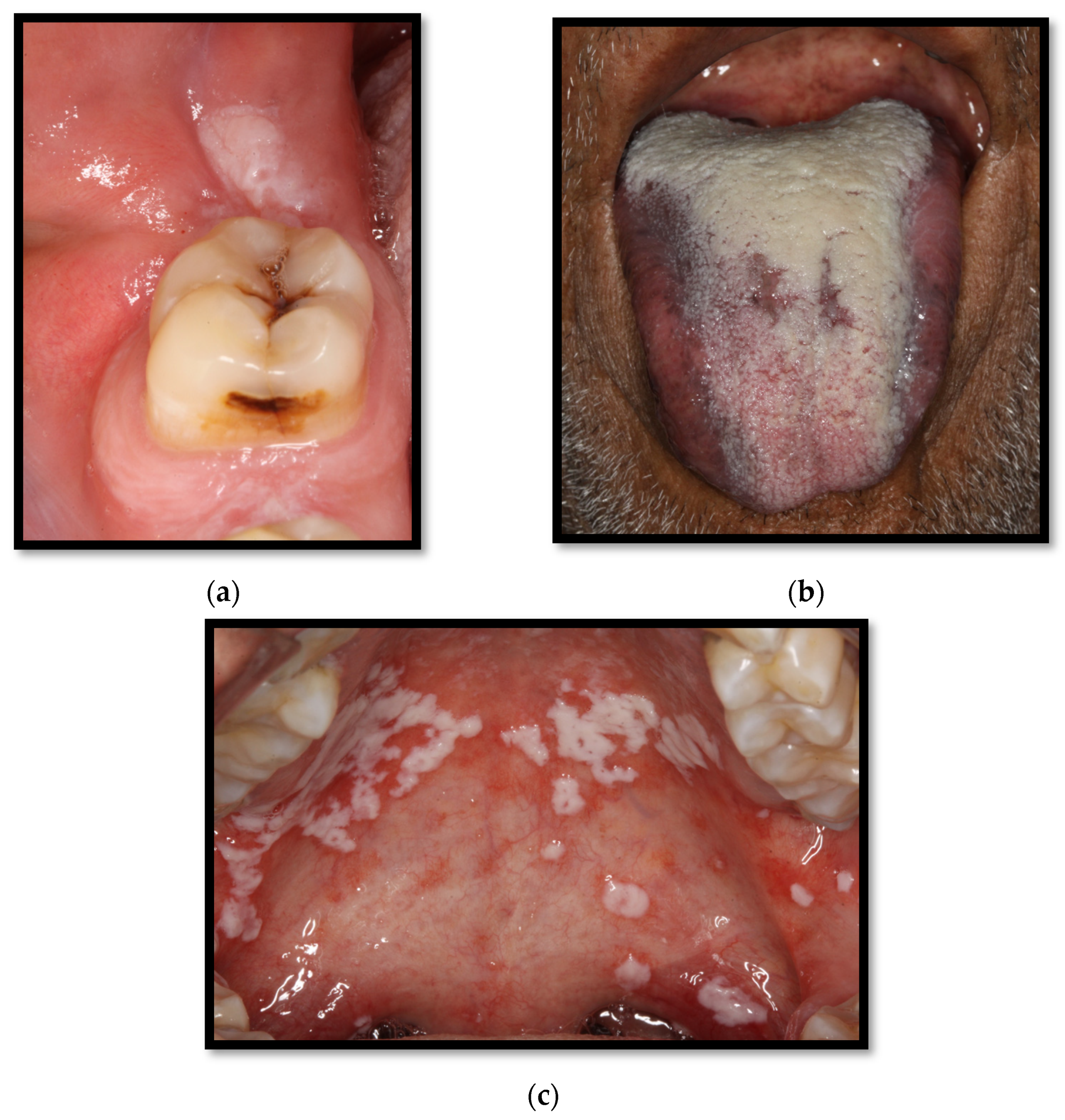 Medicina | Free Full-Text | Oral Manifestations Associated with HIV/AIDS  Patients