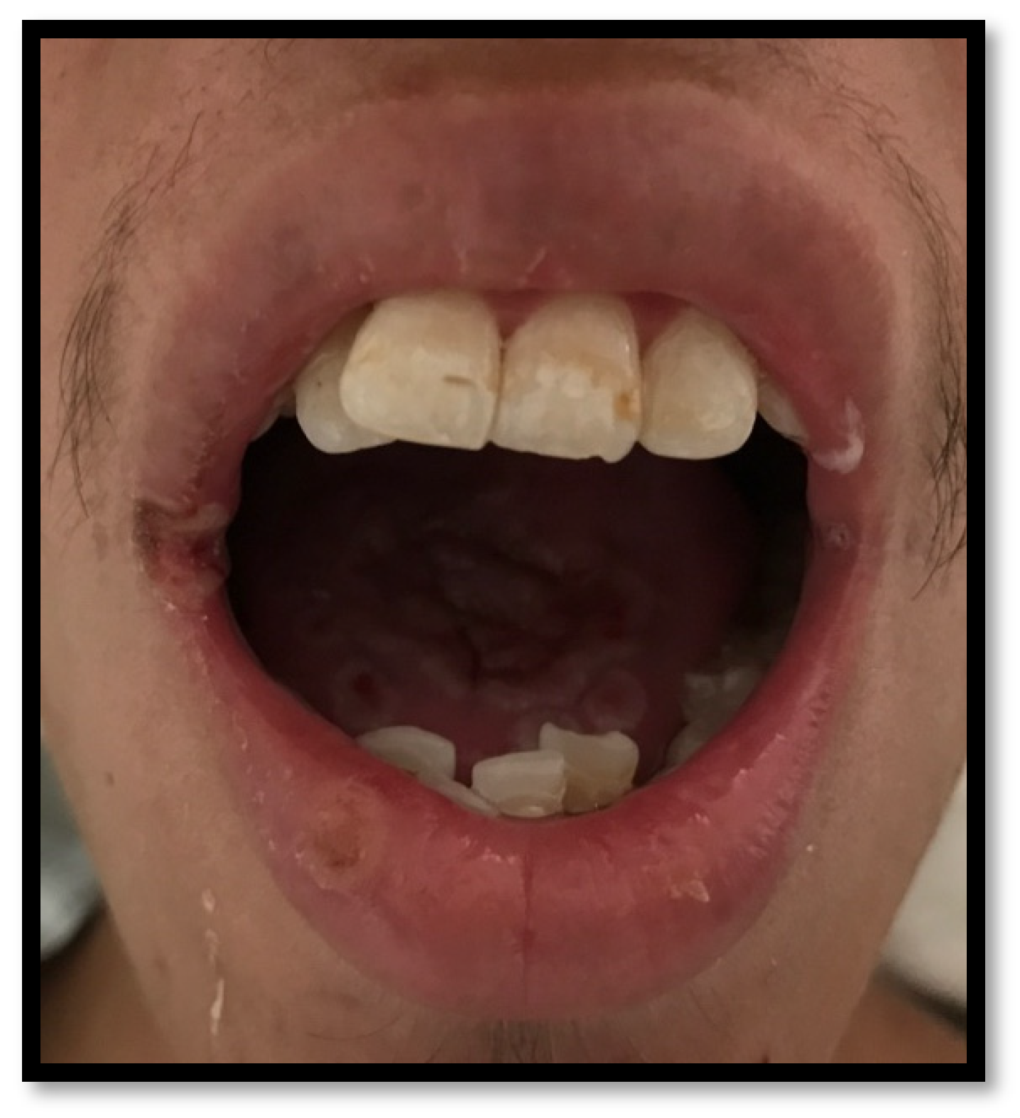Is Your Angular Cheilitis Healing? Check These Pictures! - 9f0lrt0
