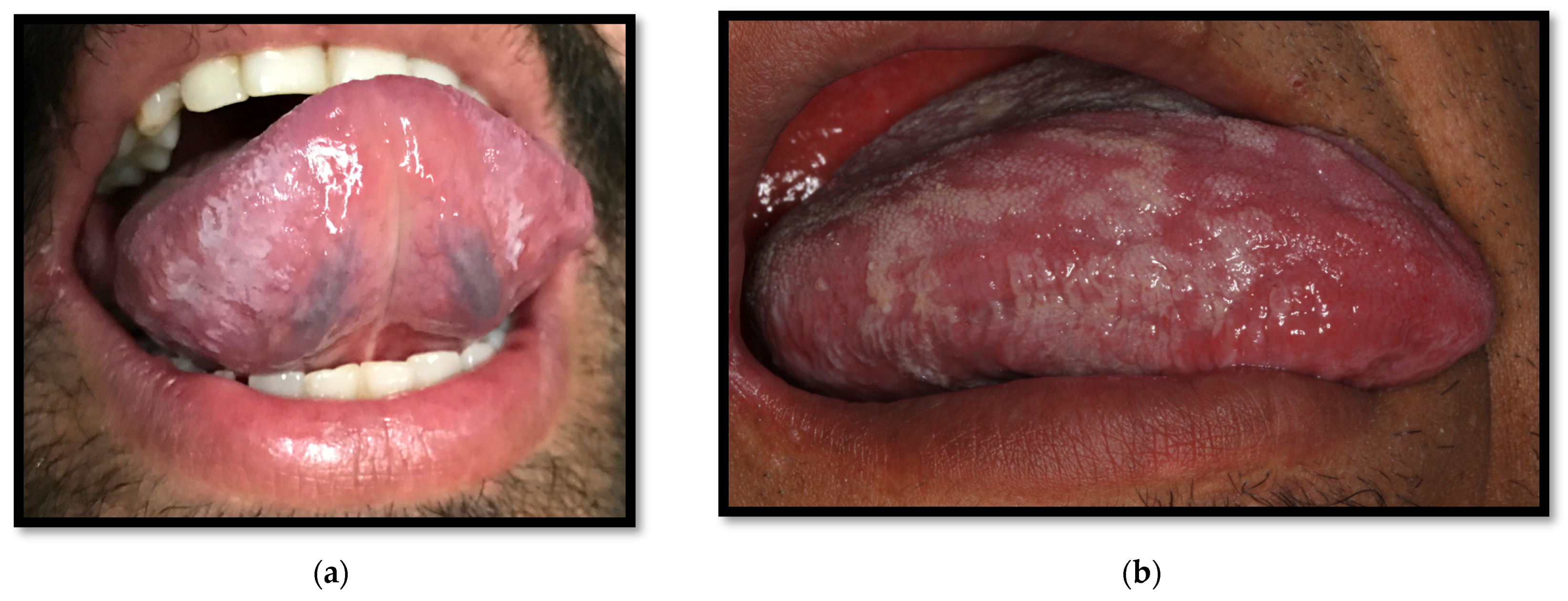 Medicina | Free Full-Text | Oral Manifestations Associated with HIV/AIDS  Patients