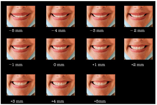 Medicina | Free Full-Text | The Influence of Gingival Exposure on Smile  Attractiveness as Perceived by Dentists and Laypersons
