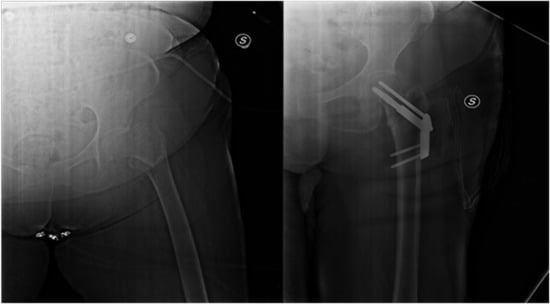 Proximal Femoral Nailing: Technical Difficulties and Results in  Trochanteric Fractures