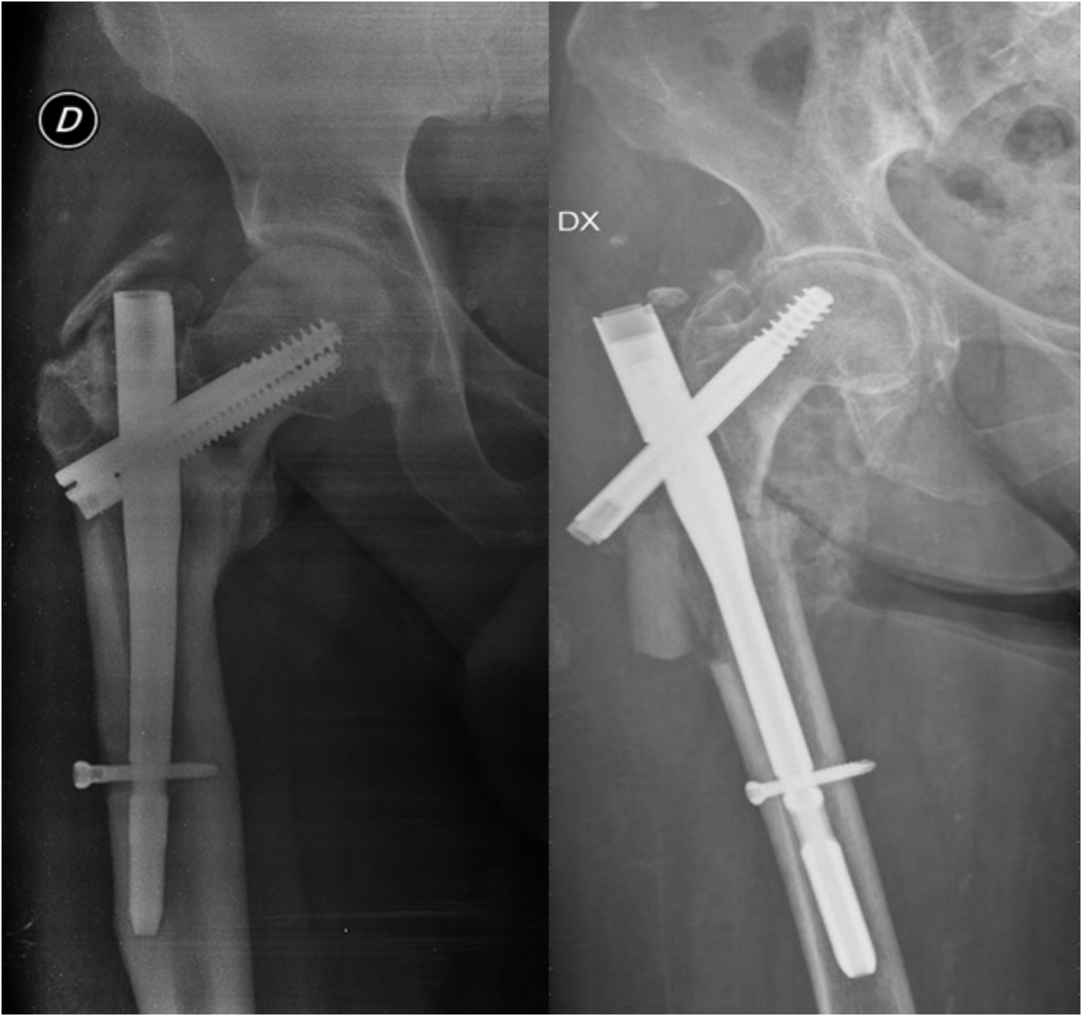 Medicina | Free Full-Text | Proximal Femoral Fractures in the Elderly: A  Few Things to Know, and Some to Forget