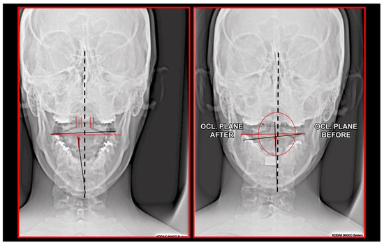 Neural Basis of Etiopathogenesis and Treatment of Cervicogenic Orofacial Pain