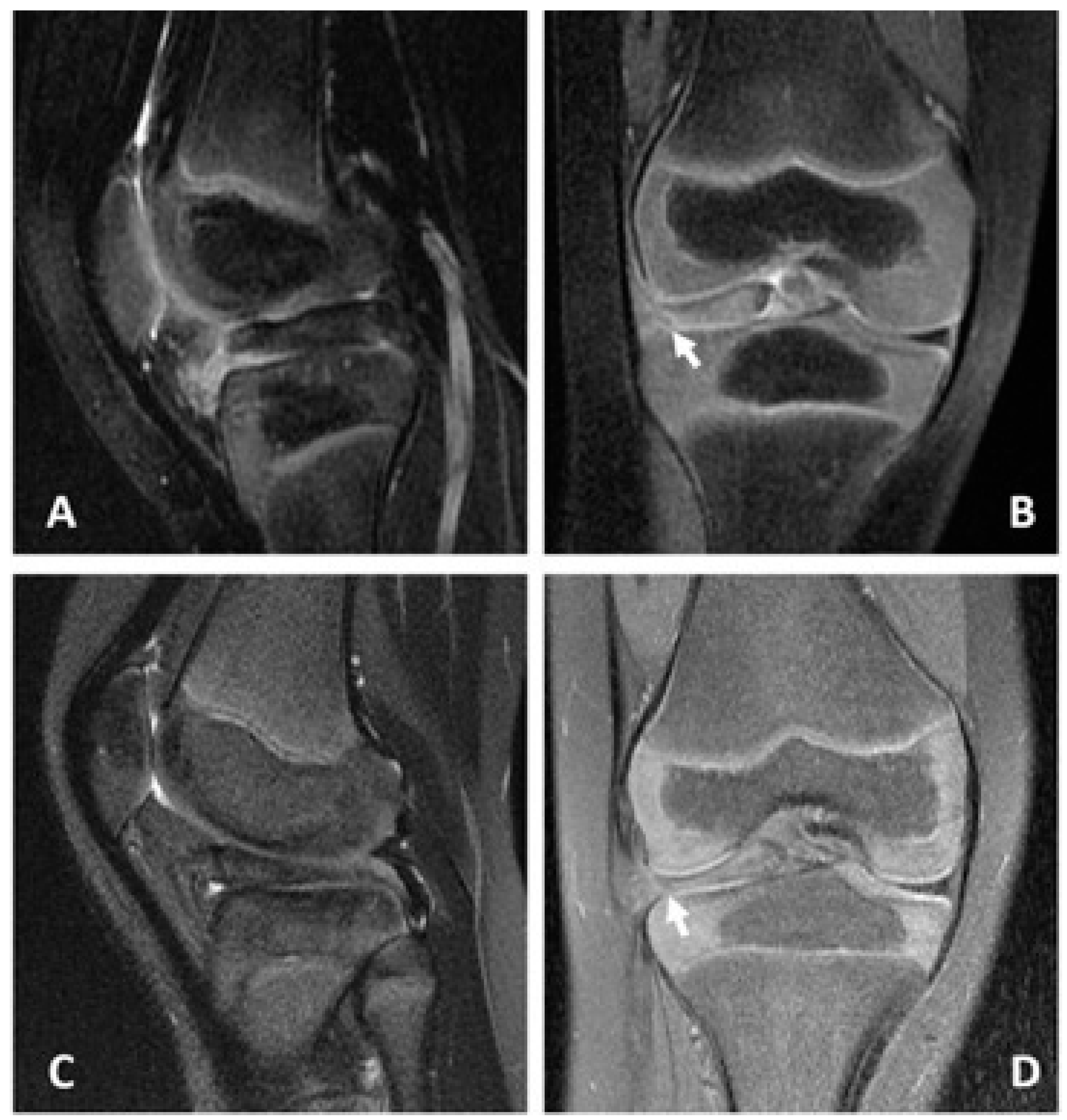 bucket handle meniscus tears
