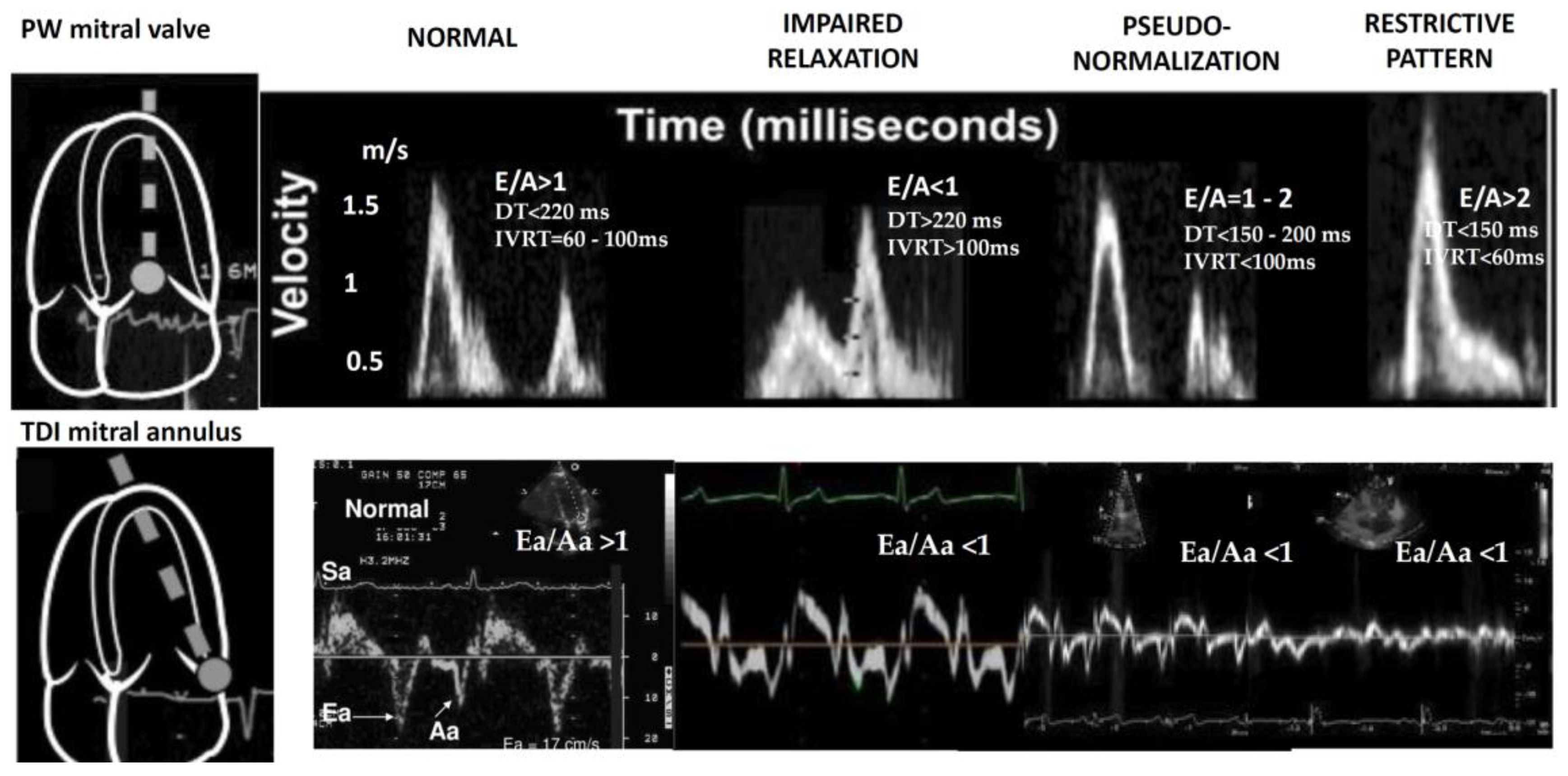 LV diastolic patterns measured by transmitral Doppler of the