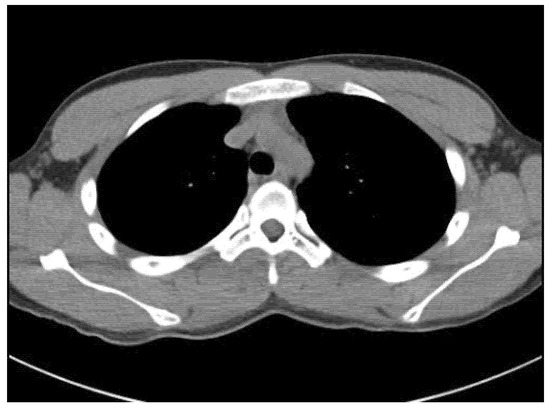 Myositis Ossificans with Aneurysmal Bone Cystic Changes at the Thoracic ...
