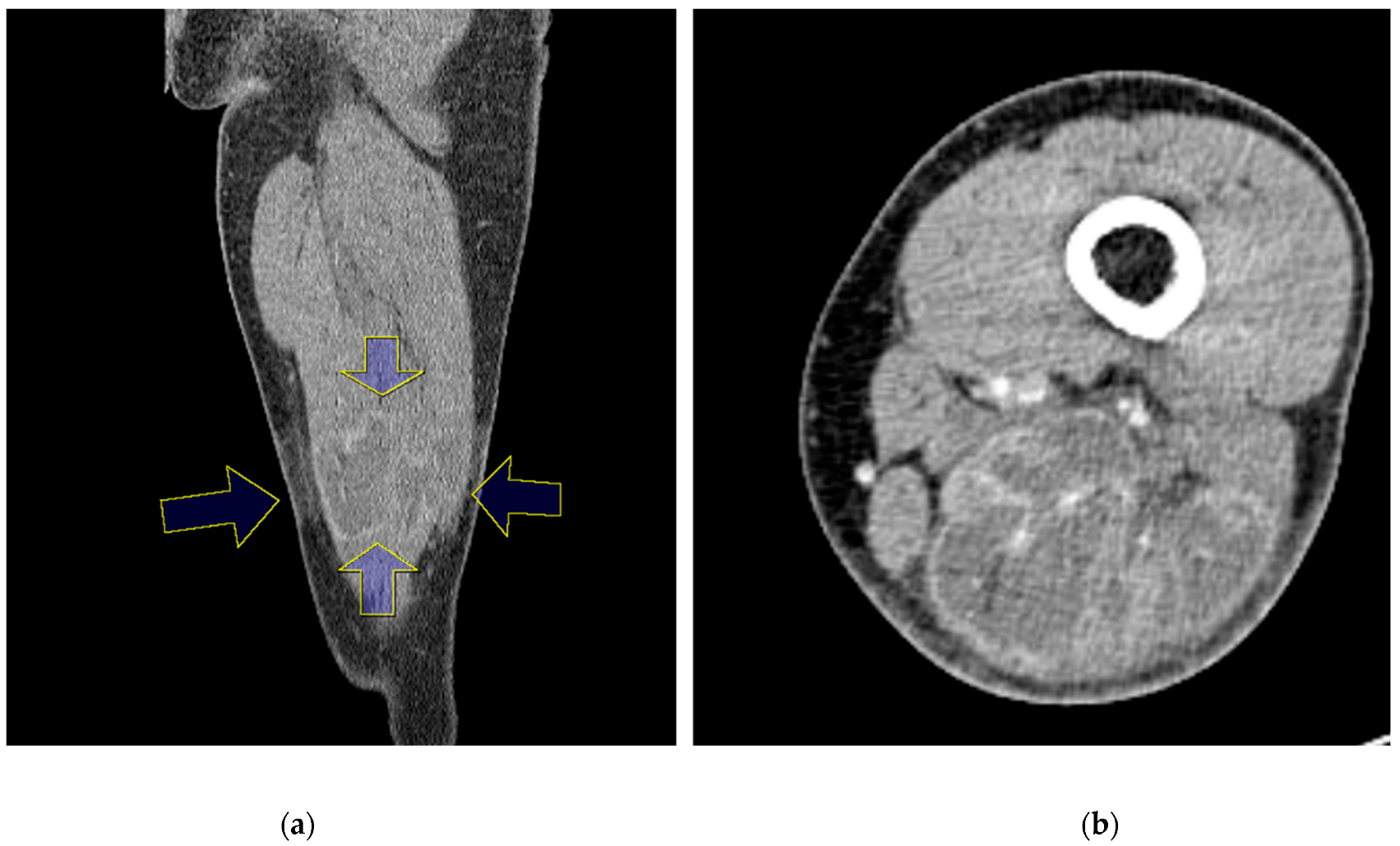 Medicina Free FullText Open Sciatic Nerve for Compartment Syndrome after