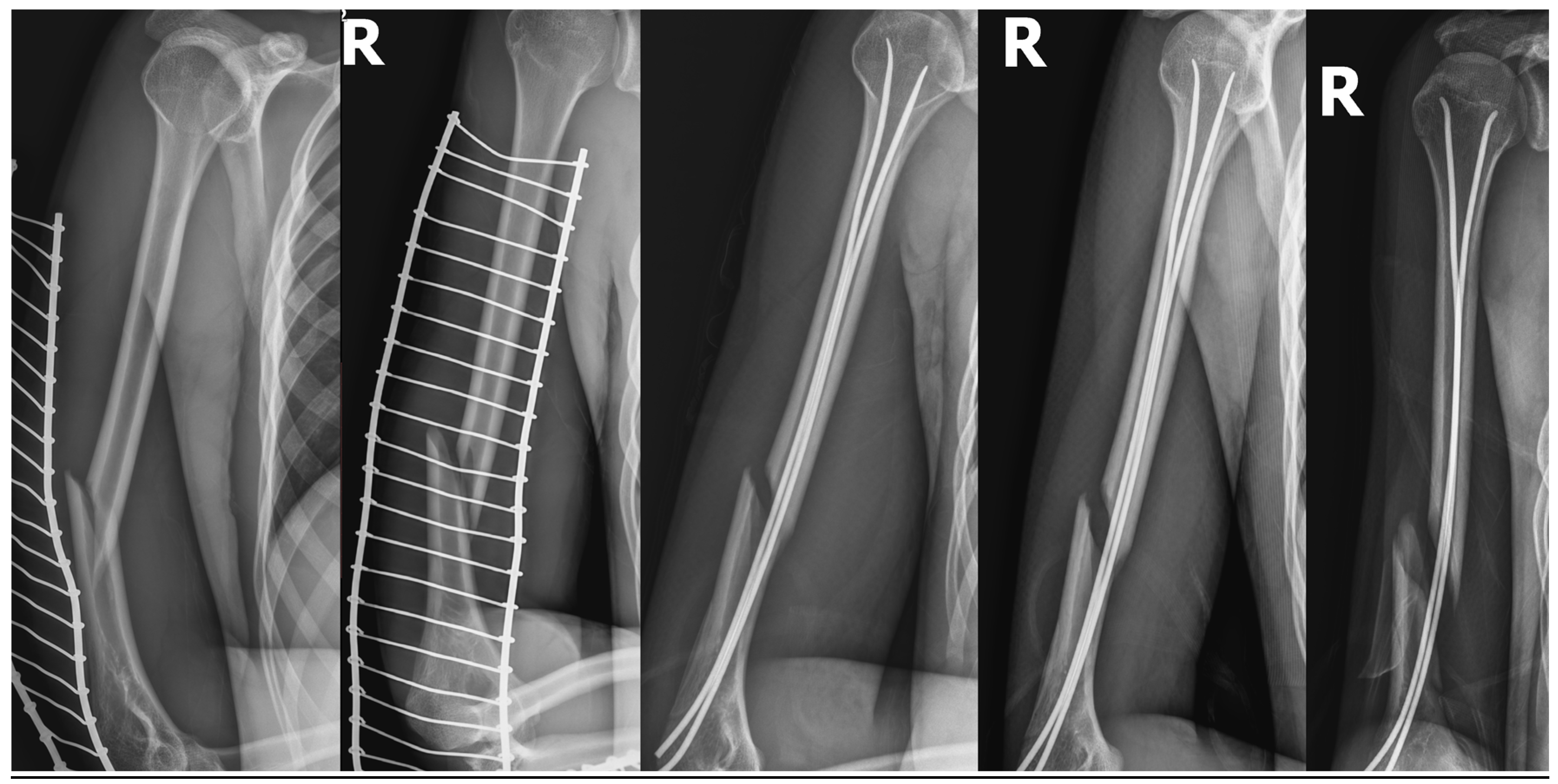 Radial Nerve Radial Nerve Humerus Fracture My XXX Hot Girl