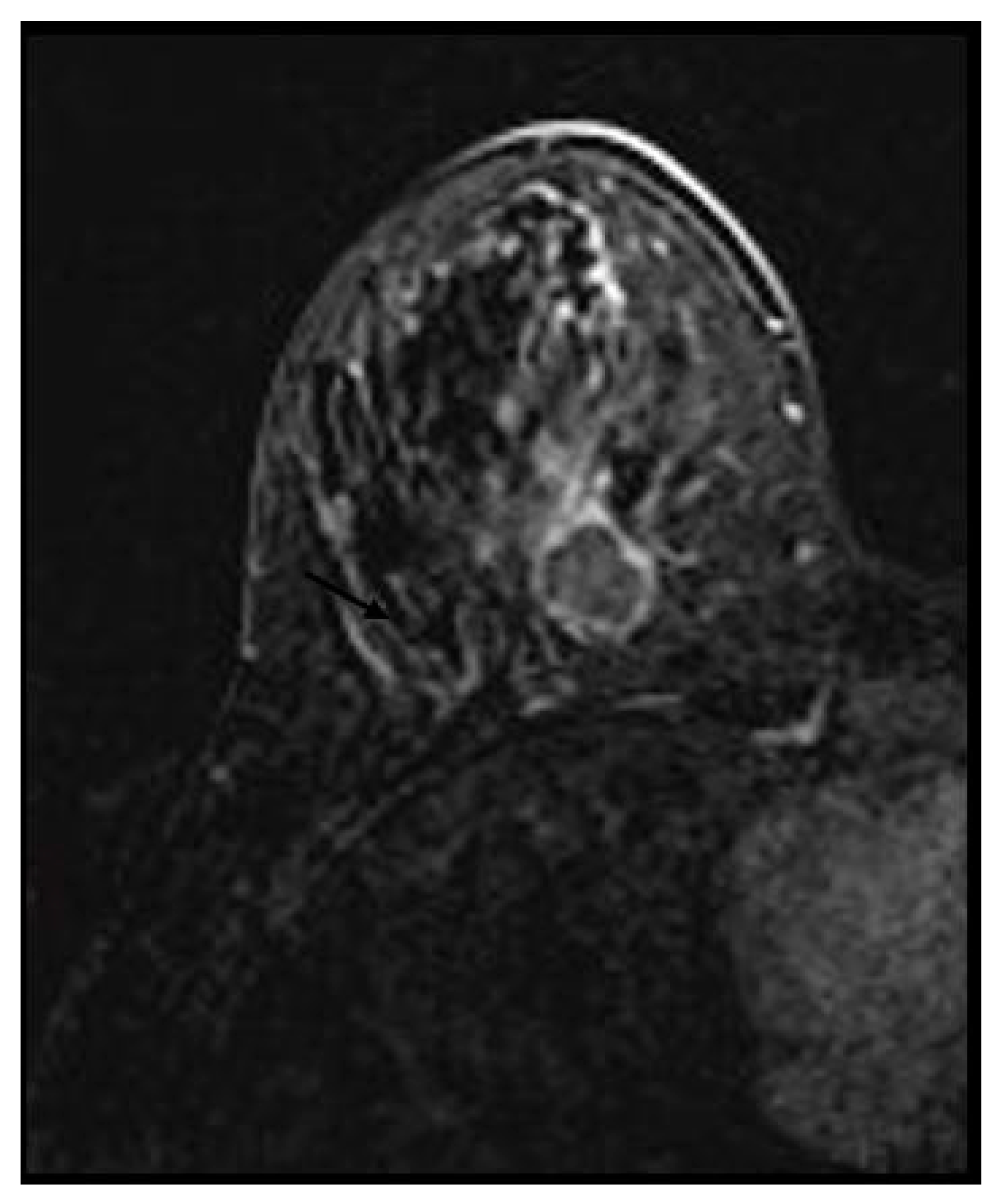 Medicina Free FullText Multiparametric MRI Features of Breast
