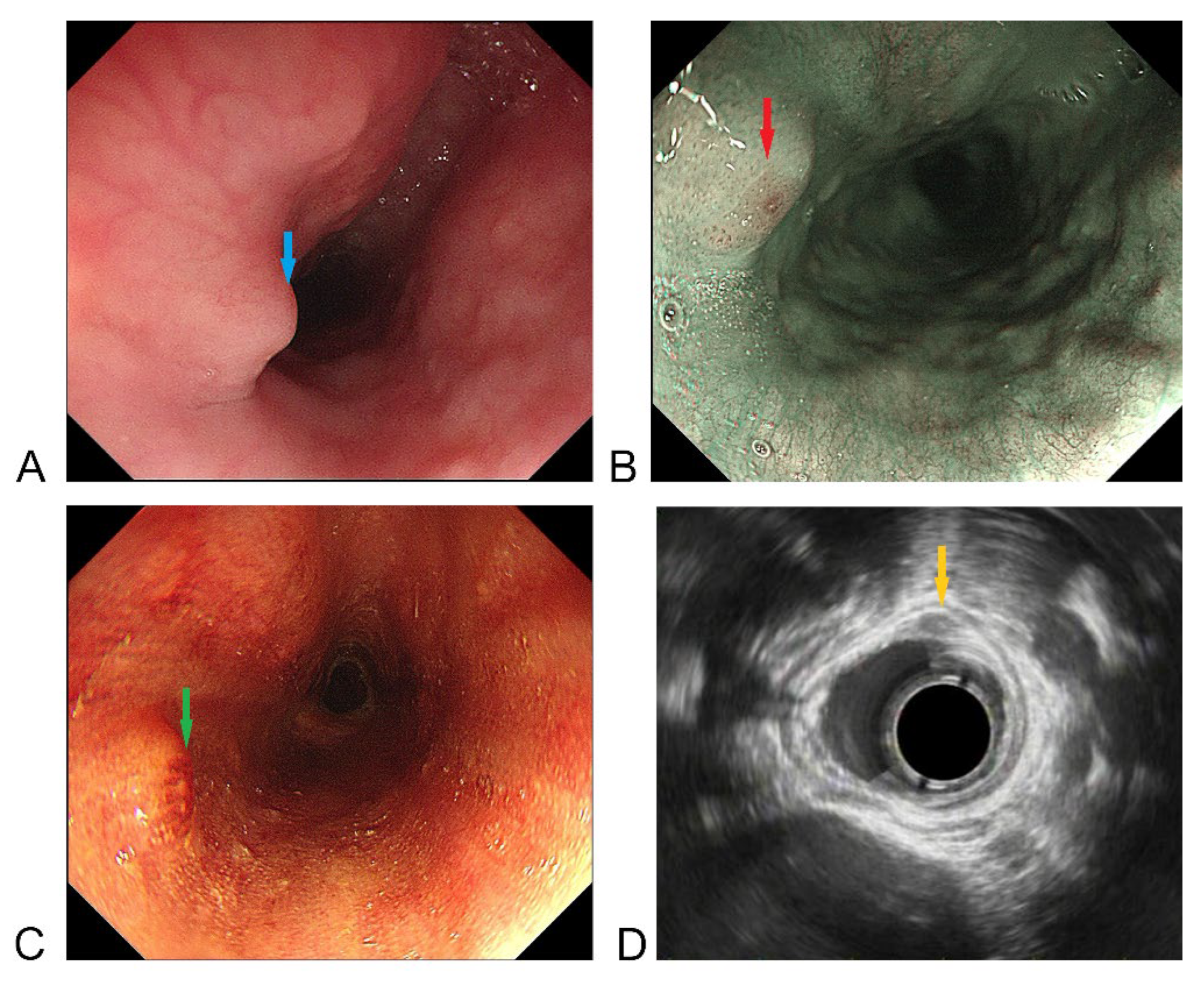 Medicina | Free Full-Text | A Submucosal Tumor-like Lesion of the Cervical  Esophagus Similar to the Tonsillar Structures of Waldeyer&rsquo;s Ring: A  Case Report