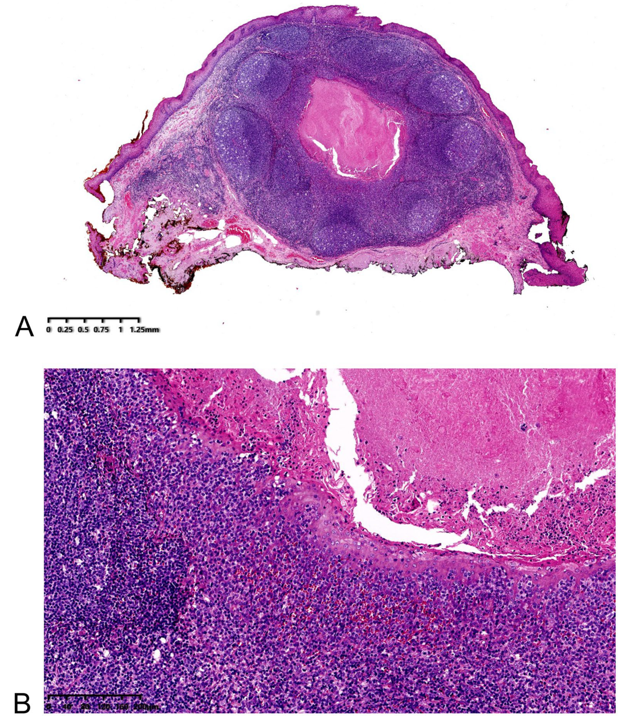 Medicina | Free Full-Text | A Submucosal Tumor-like Lesion of the Cervical  Esophagus Similar to the Tonsillar Structures of Waldeyer&rsquo;s Ring: A  Case Report