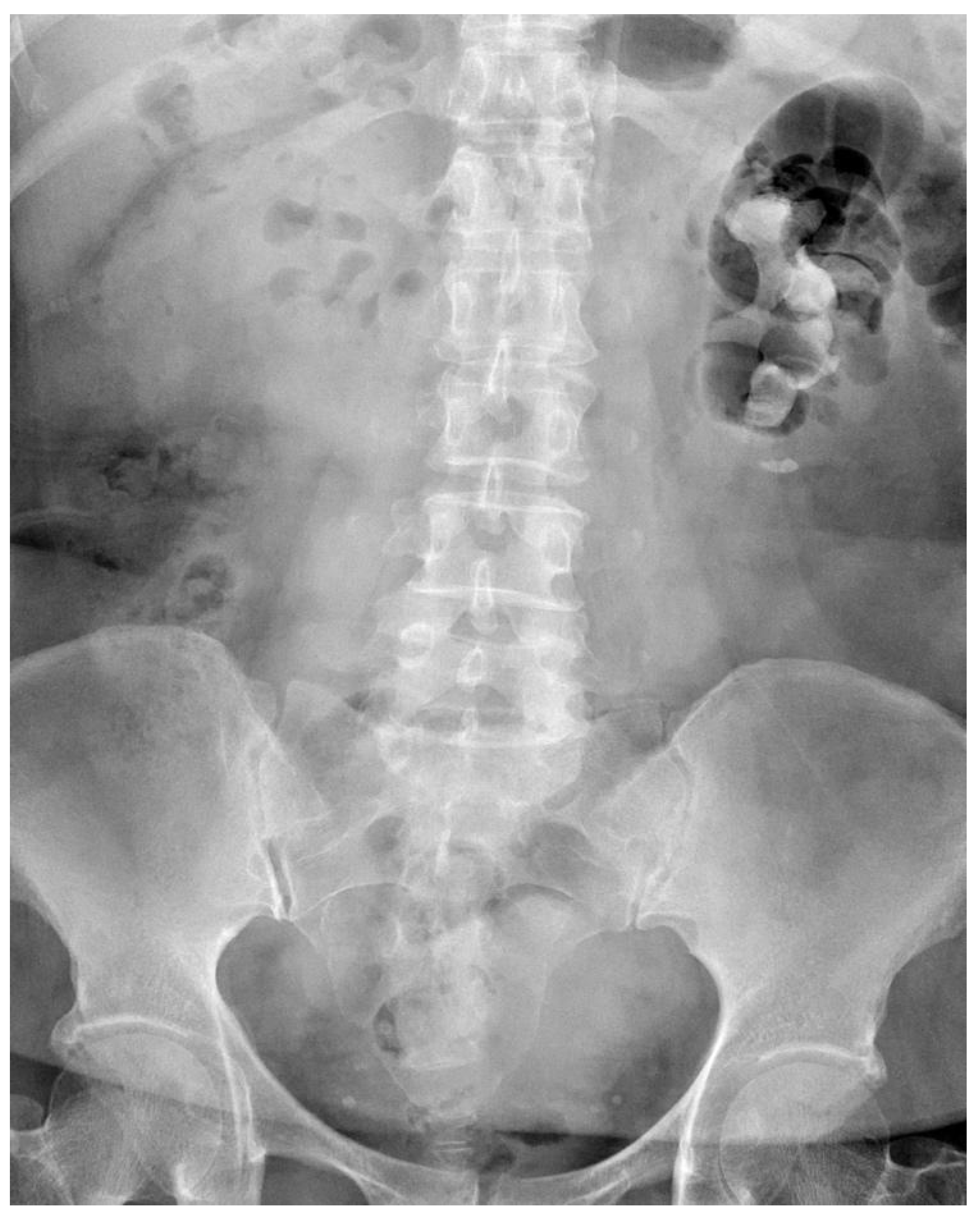 Staghorn Kidney Stones staghorn-kidney-stones