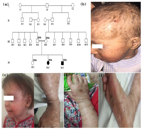 Identification and In Silico Analysis of a Homozygous
