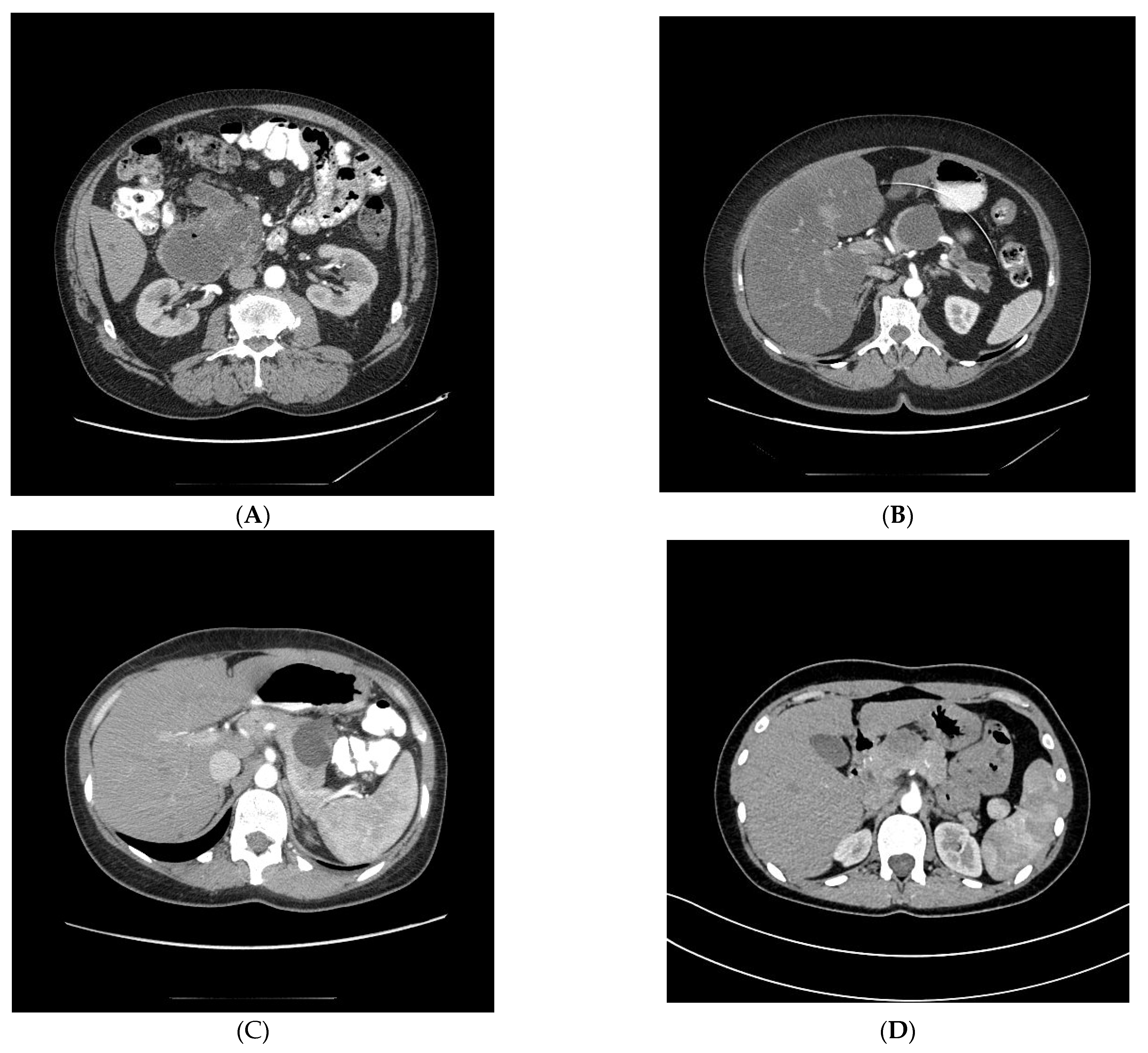 Tumors of the Pancreas (Afip Atlas of Tumor Pathology; 4th