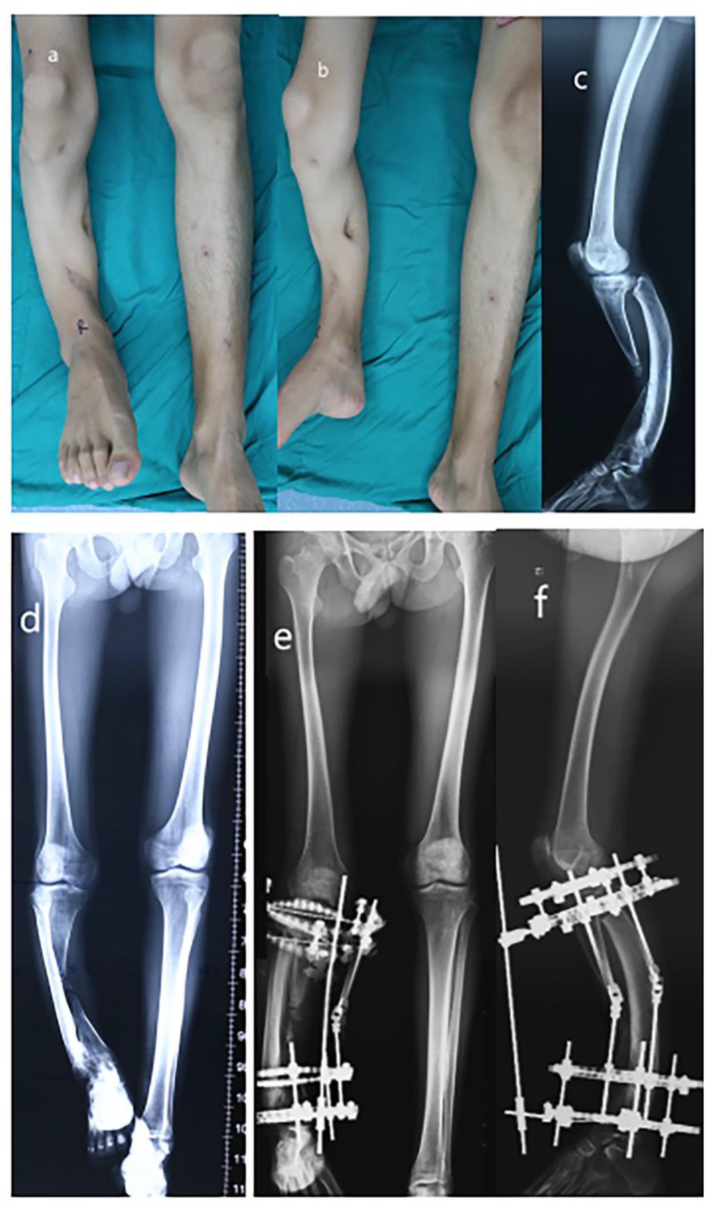 Llizarov Tibia Ring External Fixator Lengthening for Delayed