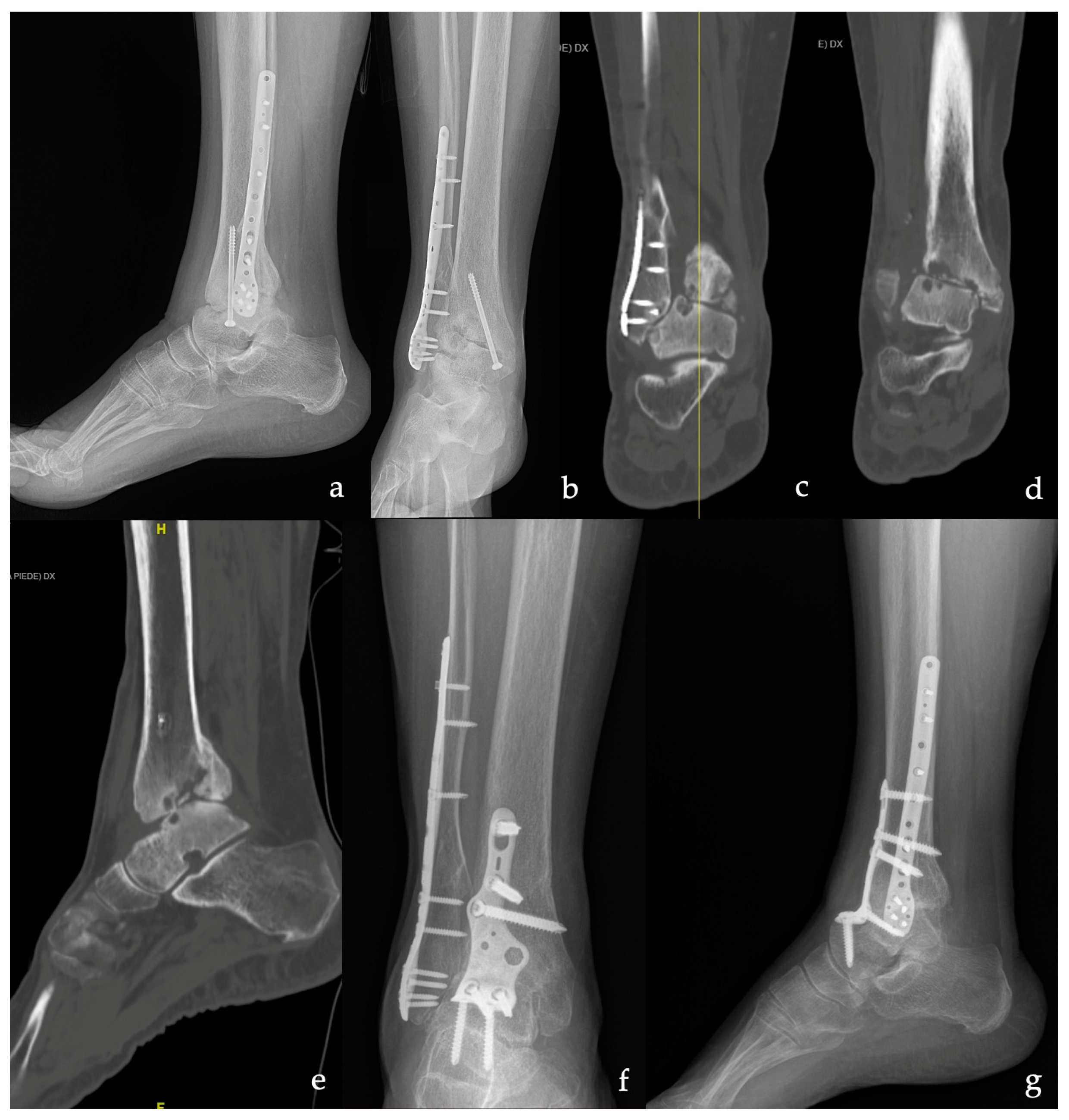 Phoenix™ Ankle Arthrodesis Nail System