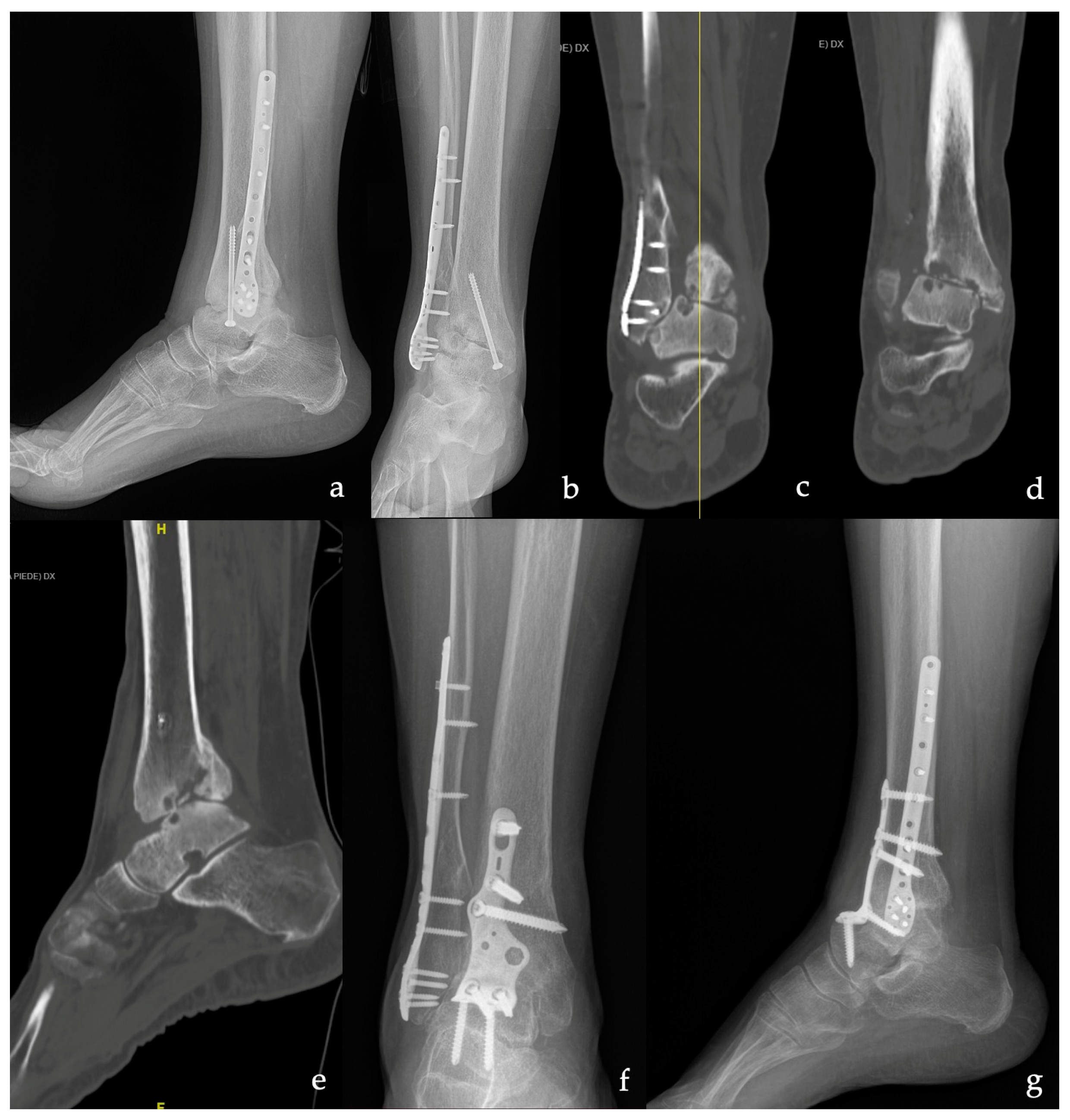 Analysis of bone transport for ankle arthrodesis as a limb salvage  procedure for the treatment of septic pilon fracture nonunion