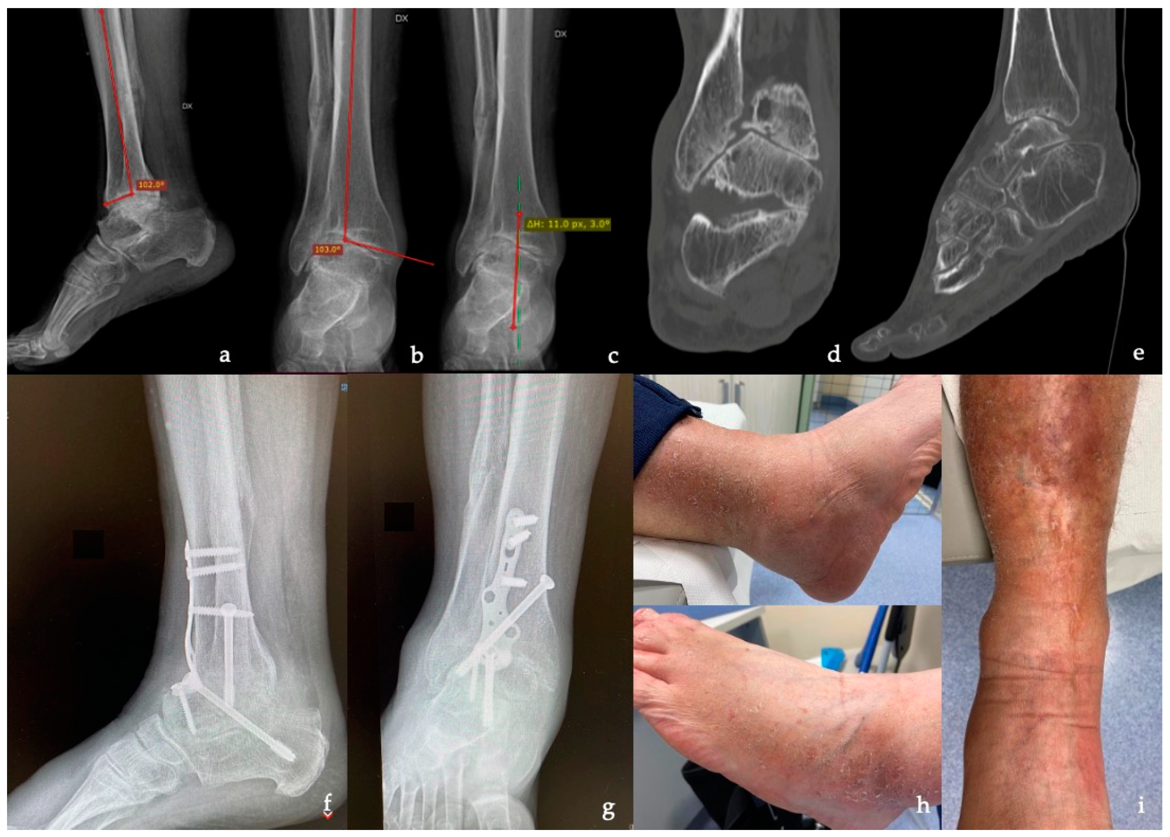 Expert Hindfoot Arthrodesis Nail - Depuy Synthes - PDF Catalogs | Technical  Documentation