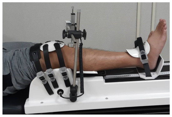Outcomes of Combined Anterior Cruciate Ligament and Anterolateral
