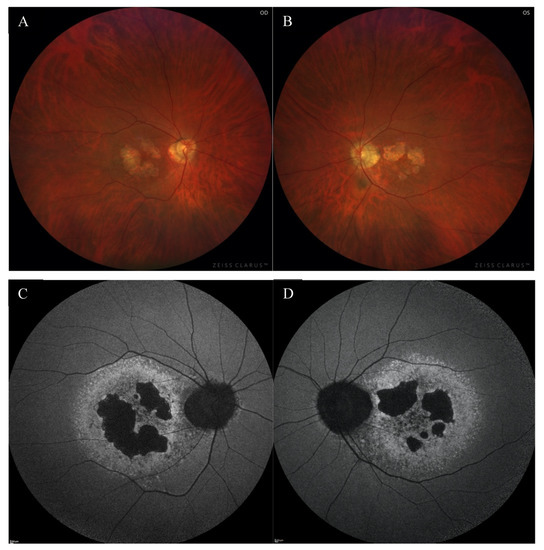 Medicina Free FullText CDHR1Related ConeRod Dystrophy Clinical
