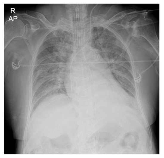 Medicina Free FullText Unexpected Tension Pneumothorax after