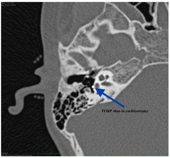 Congenital stapes suprastructure fixation presenting with