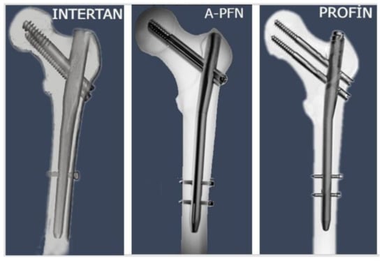 Correct placement of the femoral nail through the tip of the greater... |  Download Scientific Diagram