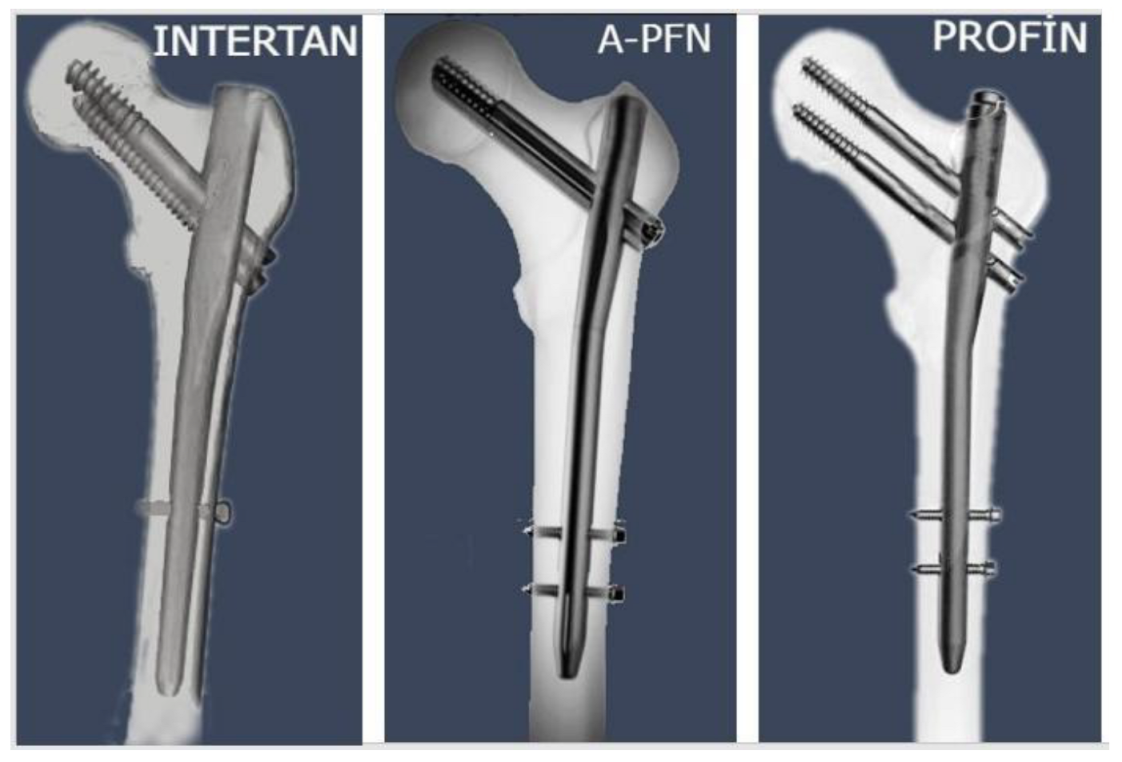 Original Article Comparision of PFN and INTERTAN nail for unstable  intertrochanteric femoral fracture in mobile patients
