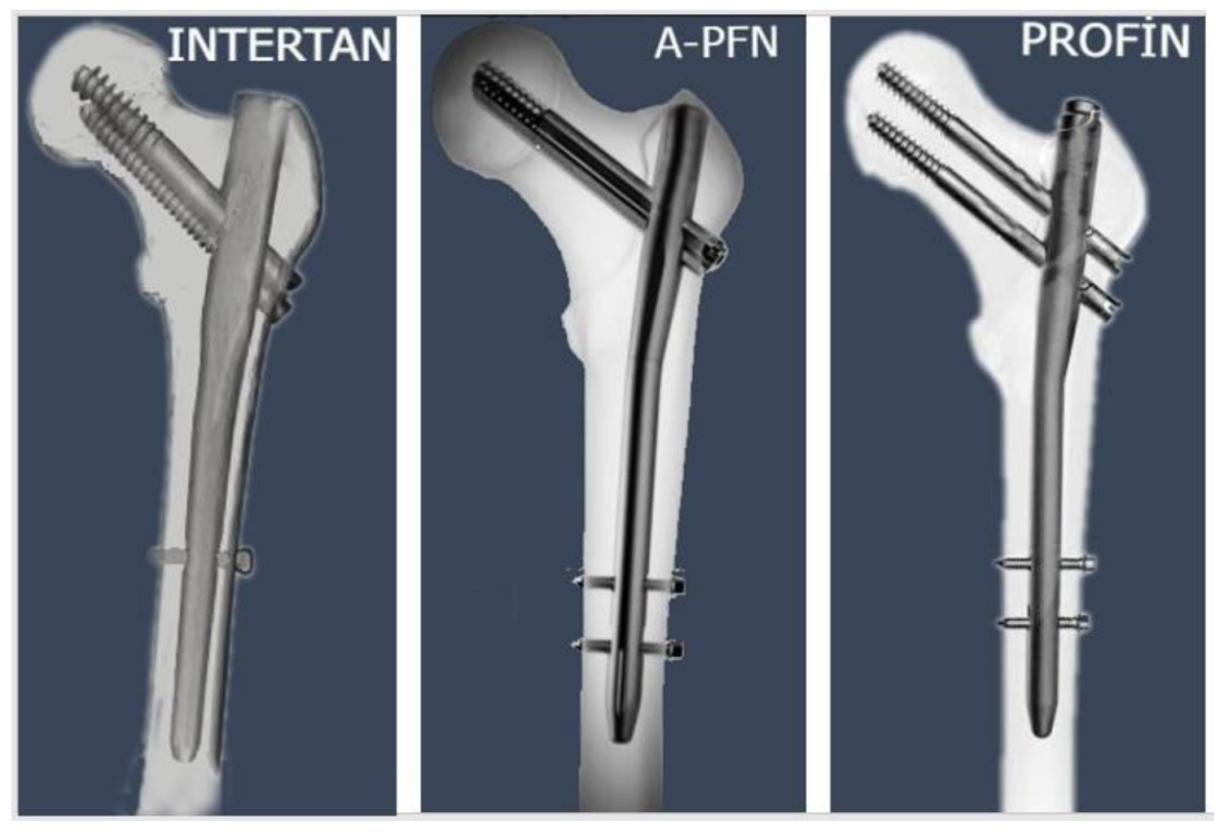 Titanium Trochanteric Fixation Nail System ... - Charles Brossard