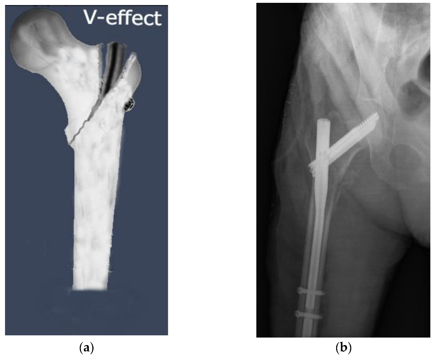PDF InterTan nail versus Gamma3 nail for intramedullary nailing of  unstable trochanteric fractures