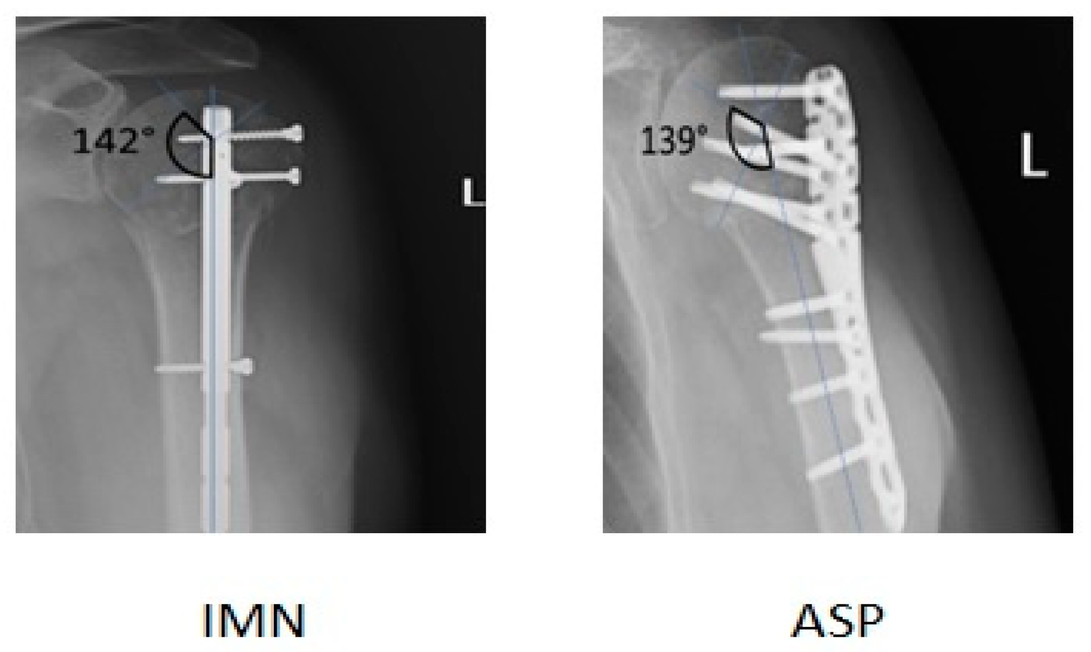 JCM | Free Full-Text | Outcomes of Mini-Invasive Arthroscopic Arthrolysis  Combined with Locking Screw and/or Intramedullary Nail Extraction after  Osteosynthesis of the Proximal Humerus Fracture